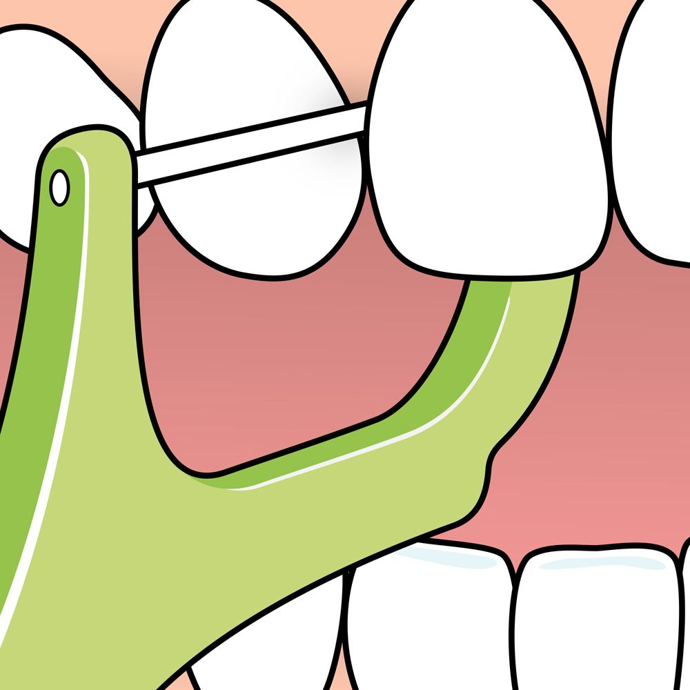Utilizzo di un infila-filo interdentale per pulire sotto un ponte dentale.