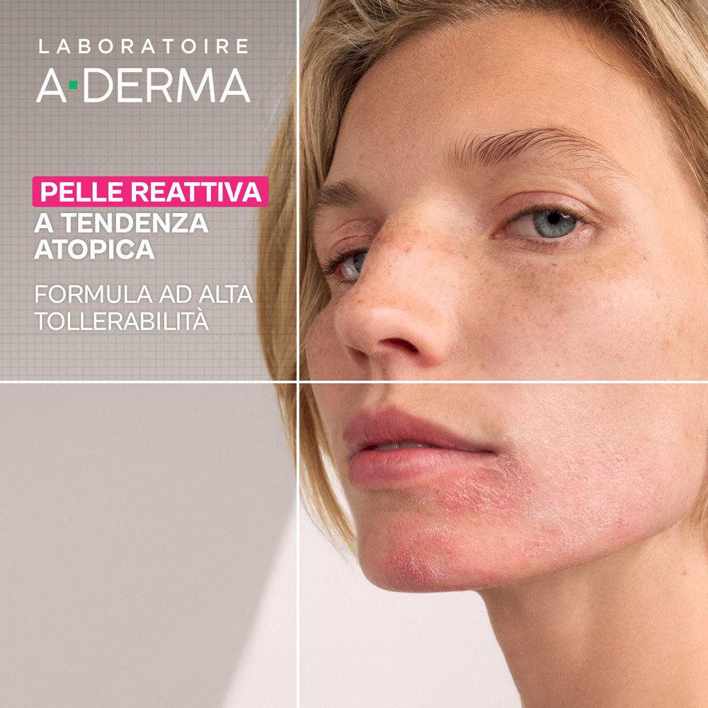 Donna con pelle reattiva atopica trattata con A-Derma Exomega.