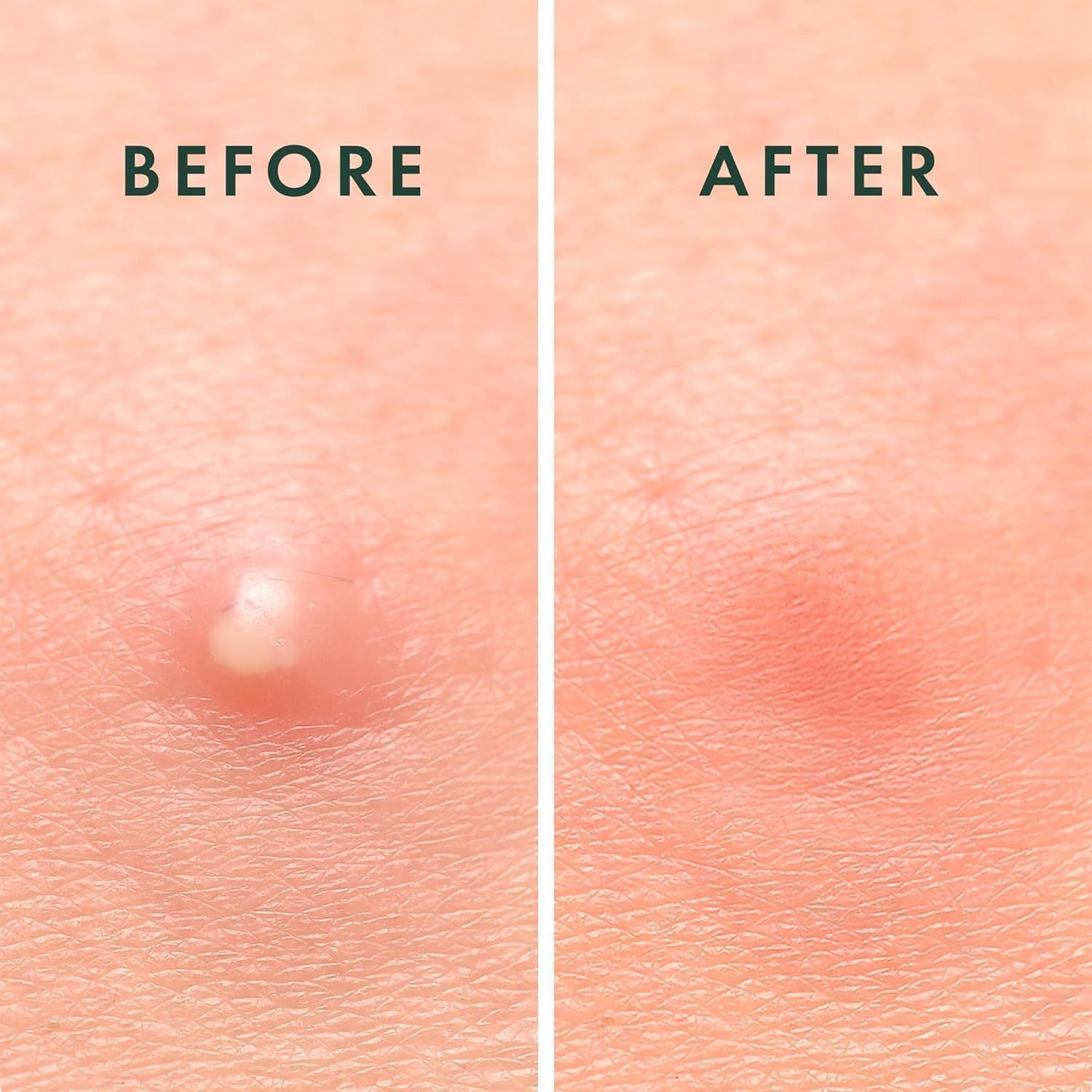 Due immagini affiancate: Prima e Dopo. Prima: brufolo. Dopo: arrossamento.