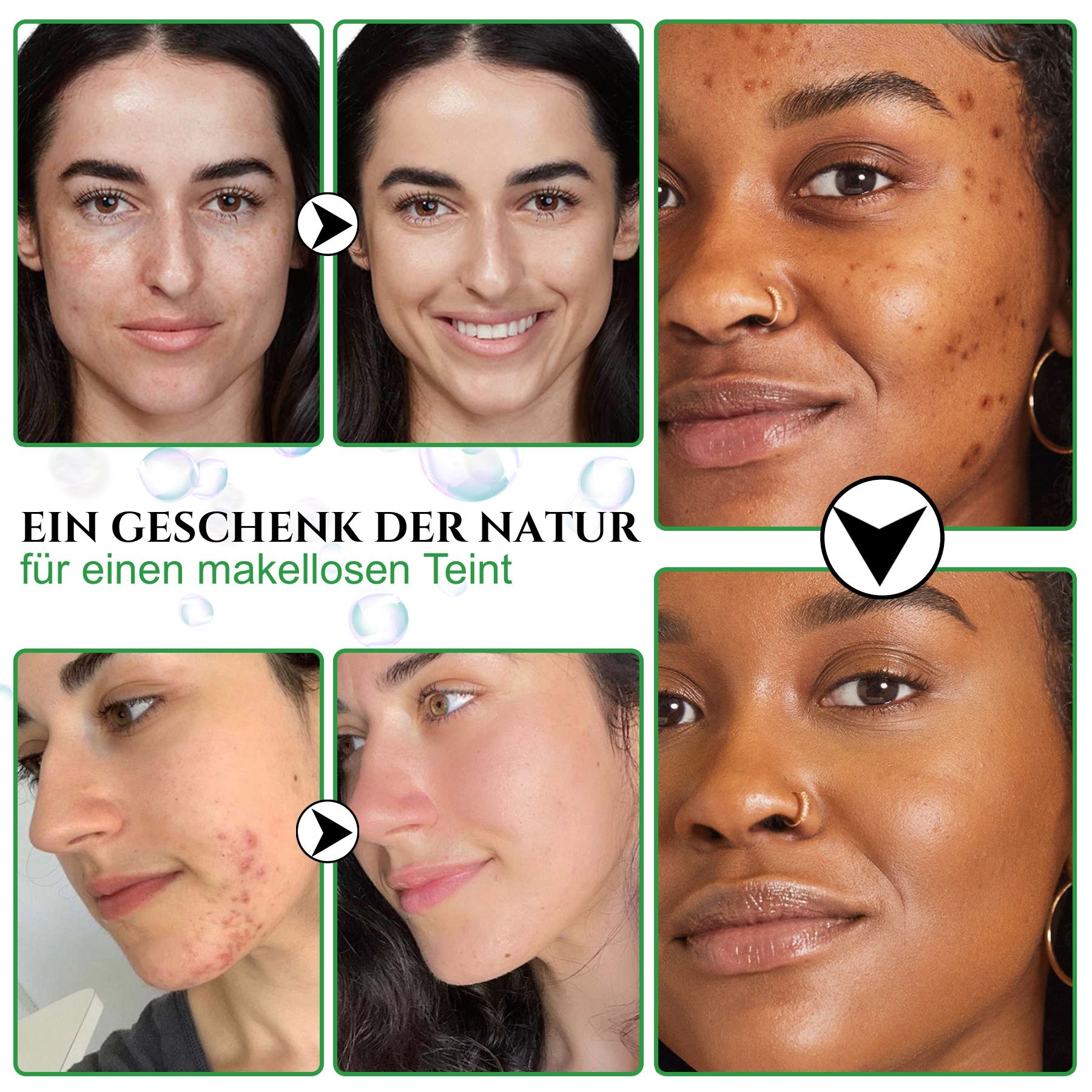 Immagini prima e dopo di volti. Testo: Un dono della natura per una carnagione impeccabile. Riduce l'acne e le imperfezioni.
