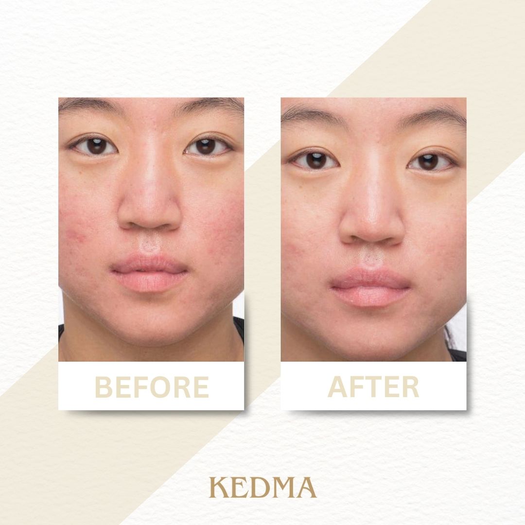Kedma - Peeling Delicato per il Viso con Estratti di Frutta