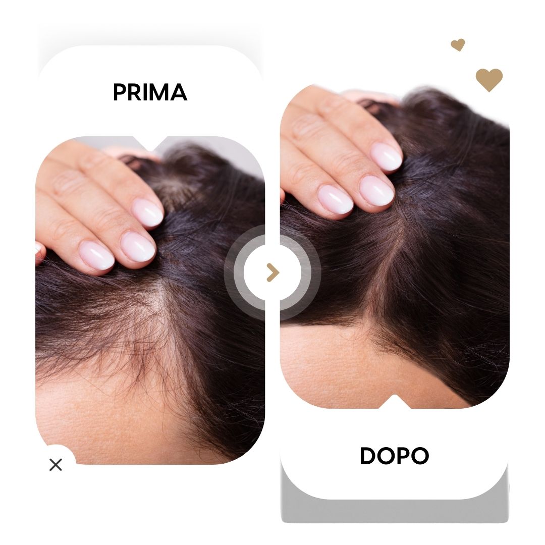 Confronto prima e dopo della linea dei capelli e della densità.