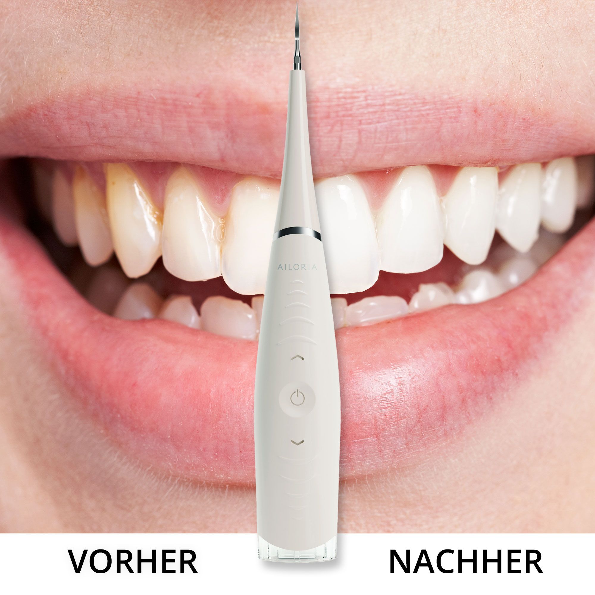 Pulitore dentale prima e dopo l'uso. Denti mostrati con e senza scolorimento.