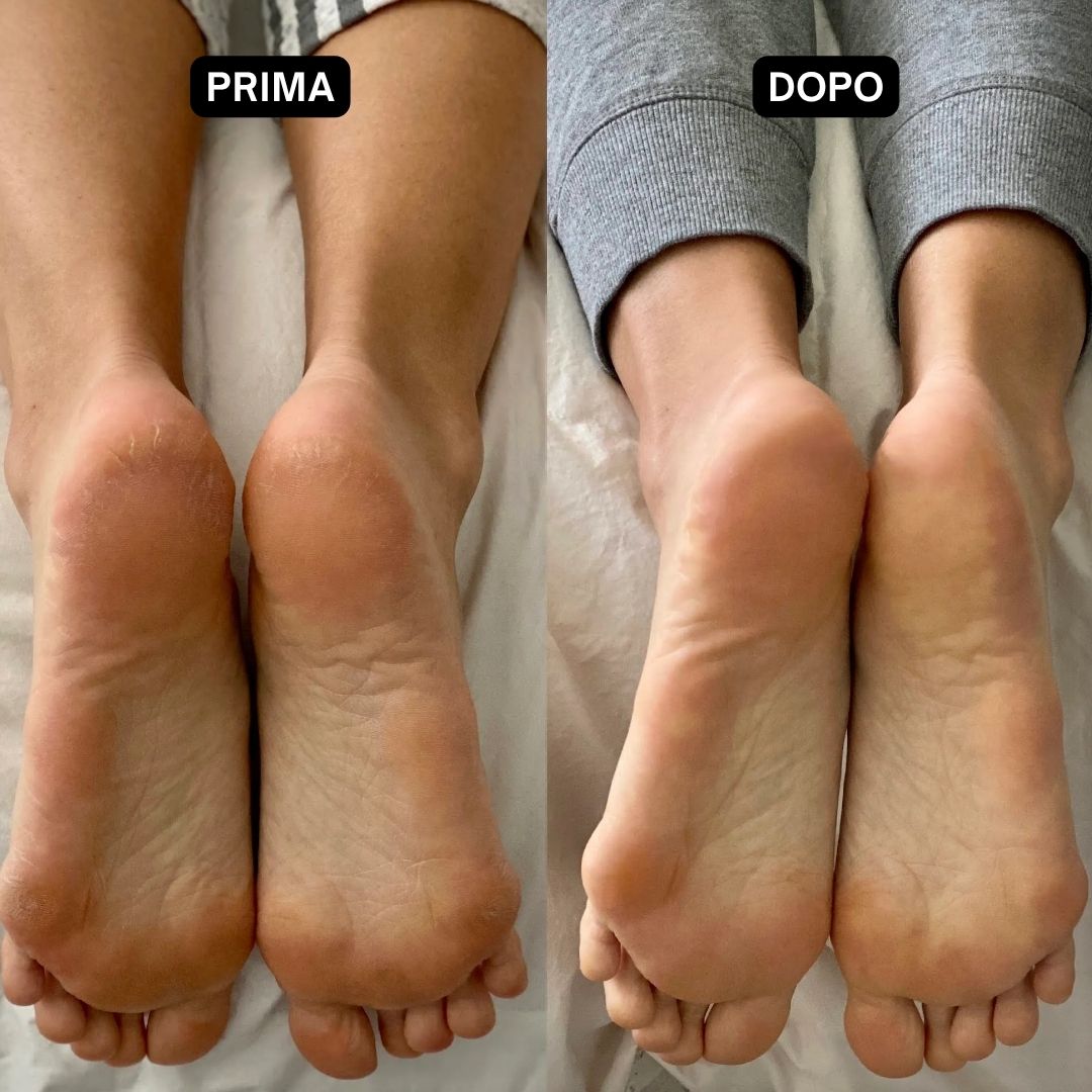 Confronto prima-dopo dei piedi. Sinistra: talloni screpolati. Destra: piedi lisci. Testo: Prima, Dopo.
