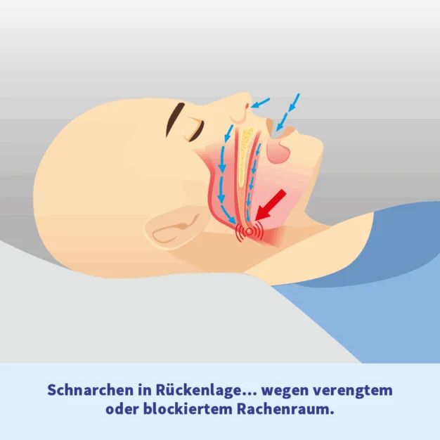Illustrazione: Uomo di profilo, russamento in posizione supina. Freccia rossa mostra restringimento vie aeree. Testo: Russamento...