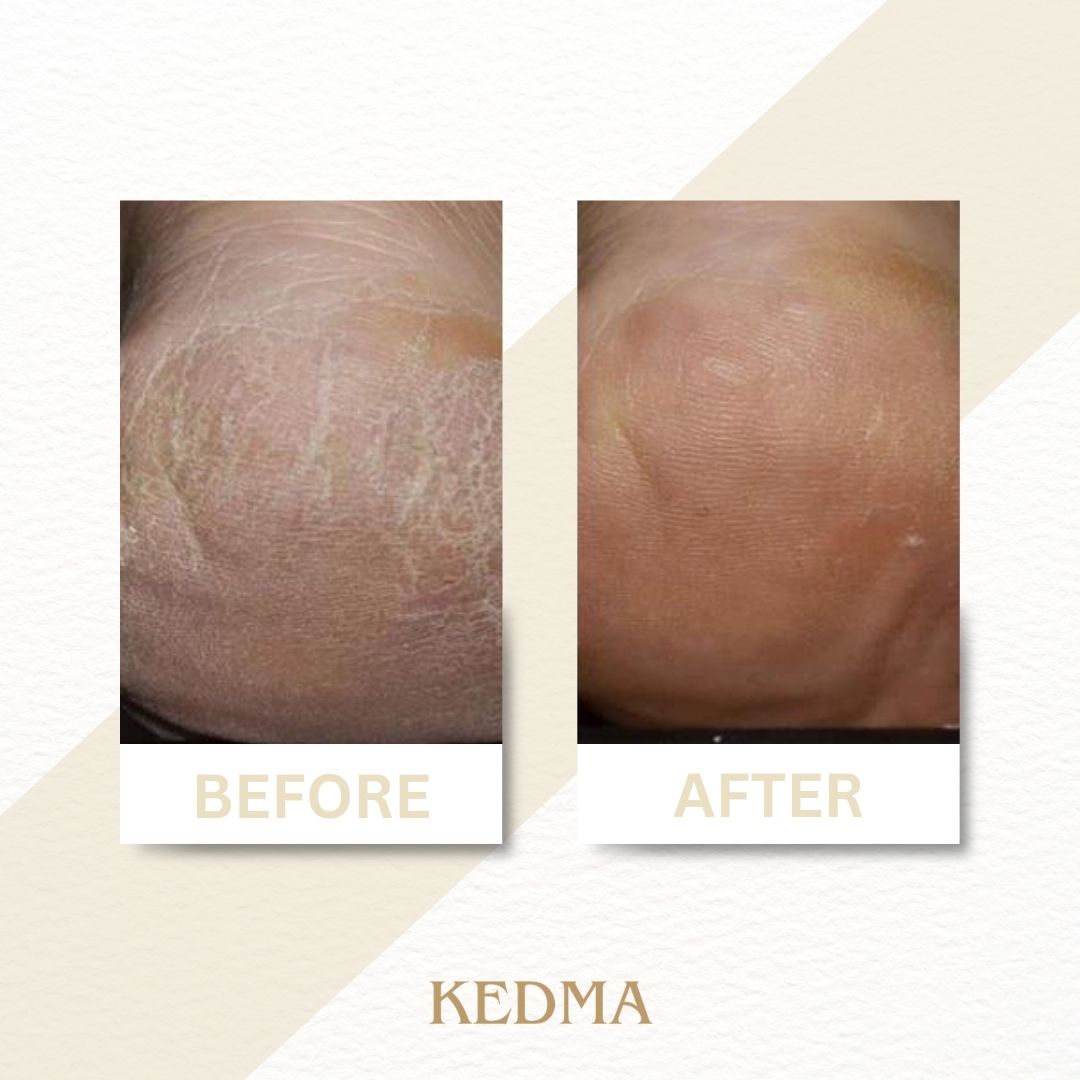 Kedma - Crema Piedi con Minerali del Mar Morto