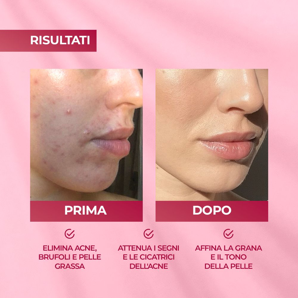 Immagine prima-dopo. Viso con imperfezioni, poi pelle liscia. Testo: Elimina l'acne, affina la grana della pelle.