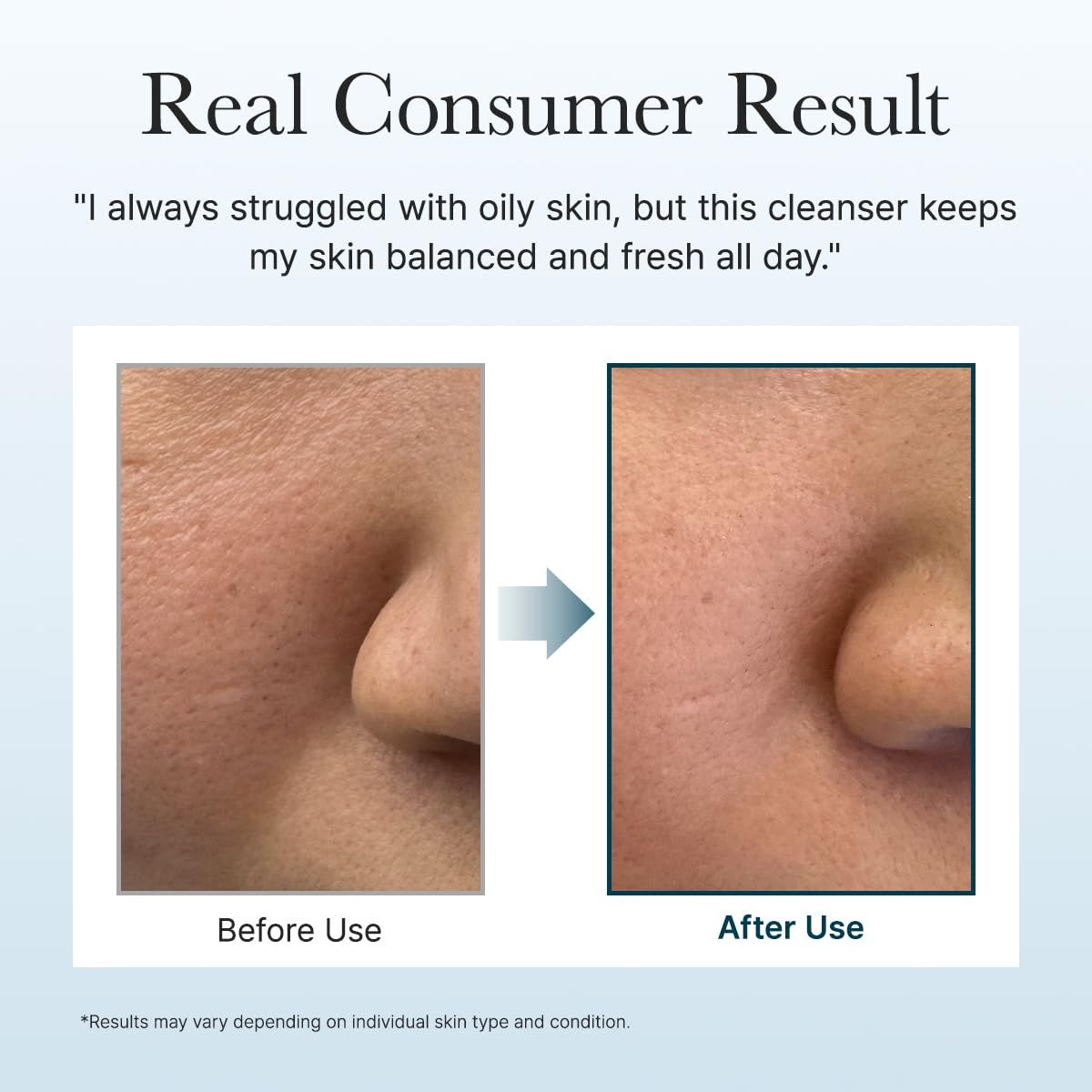 Confronto prima-dopo. Pelle del viso prima e dopo l'uso. Testo: Real Consumer Result. I risultati possono variare.