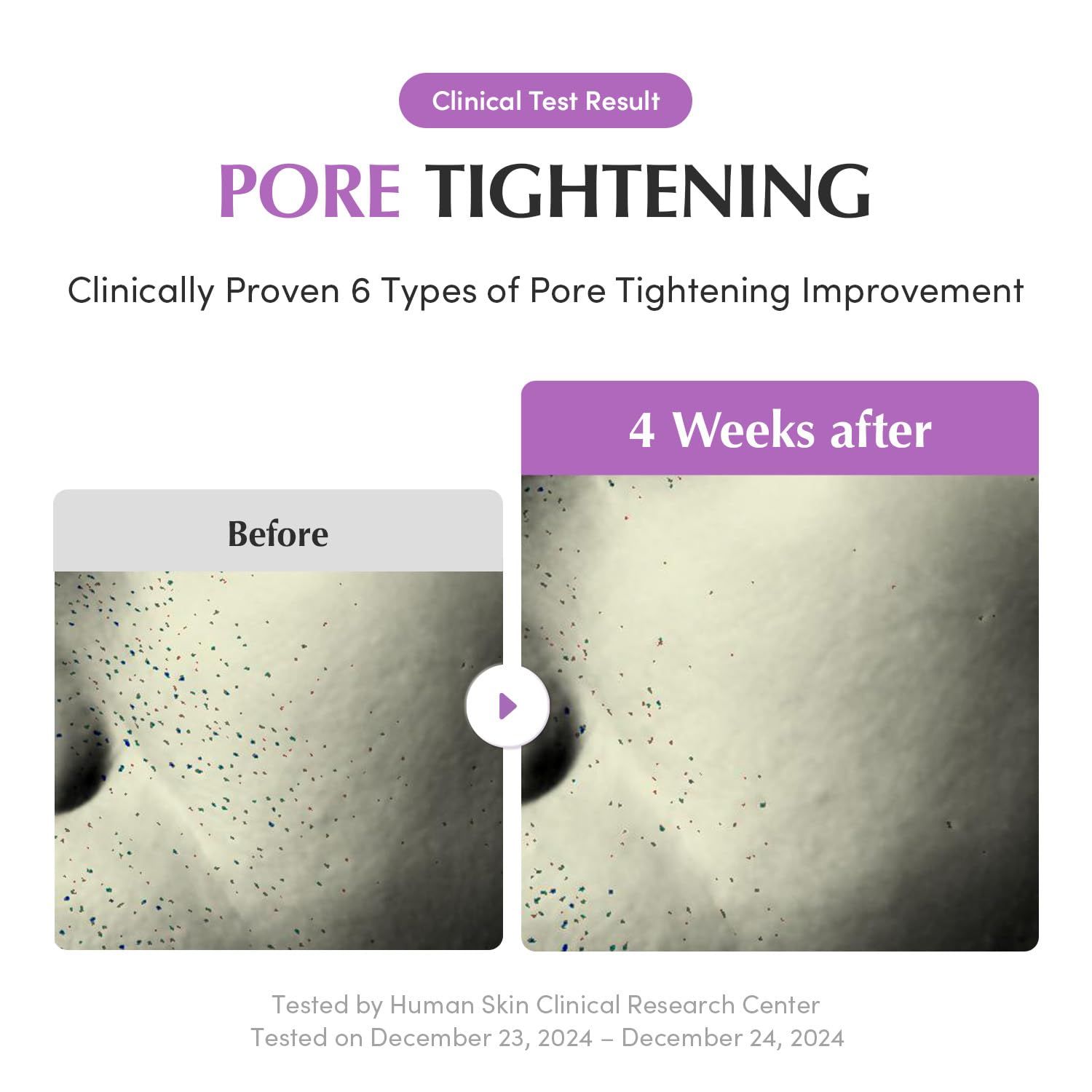 Confronto prima-dopo. Pelle con pori prima e dopo 4 settimane di trattamento. Testo: Pore Tightening. Testato clinicamente.