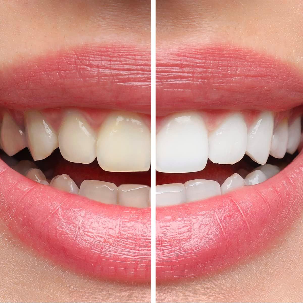 Primo piano di una bocca. Denti prima e dopo lo sbiancamento. Labbra rosse. Denti bianchi.