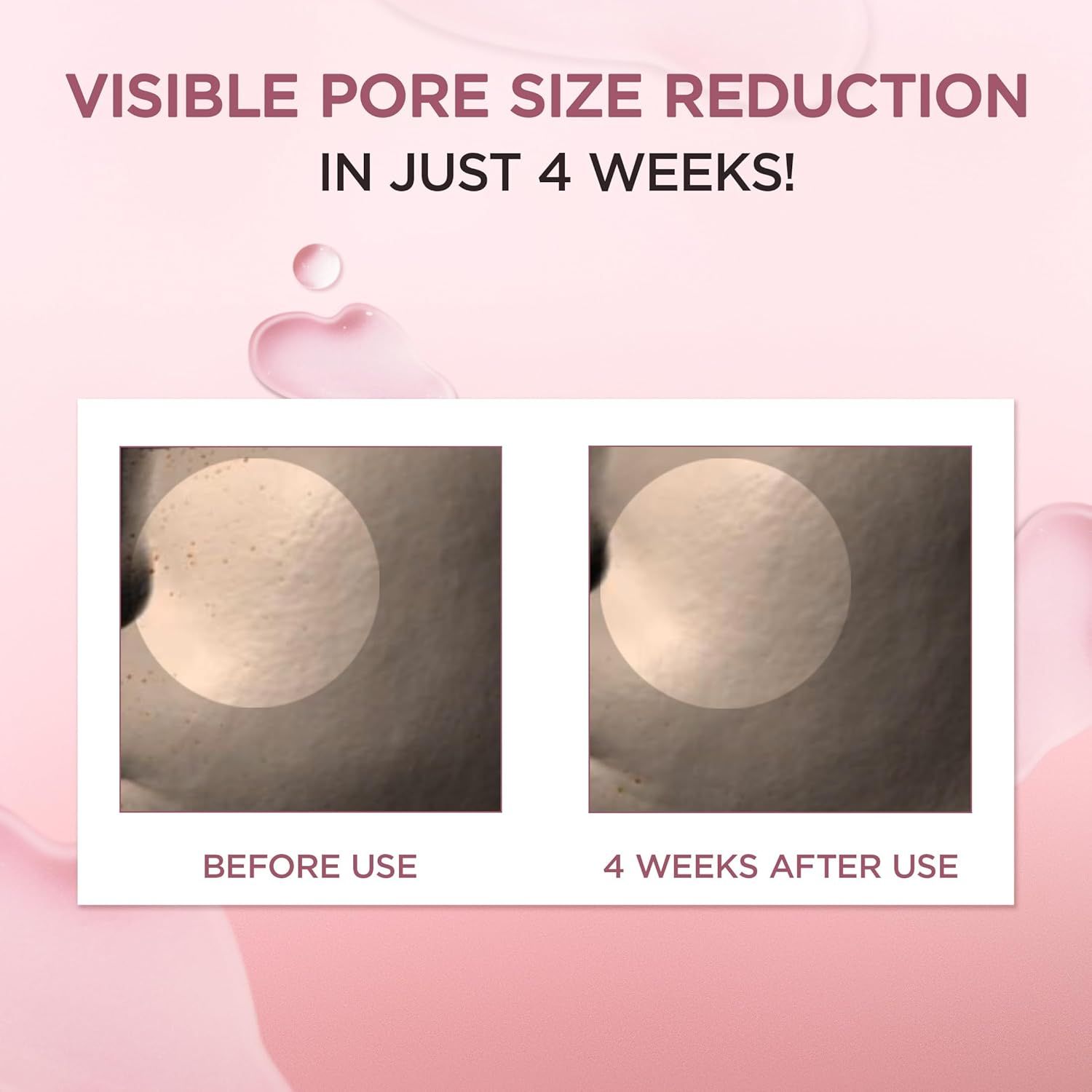 Confronto prima-dopo. Due cerchi mostrano i pori prima e dopo 4 settimane. Testo: Visible Pore Size Reduction.