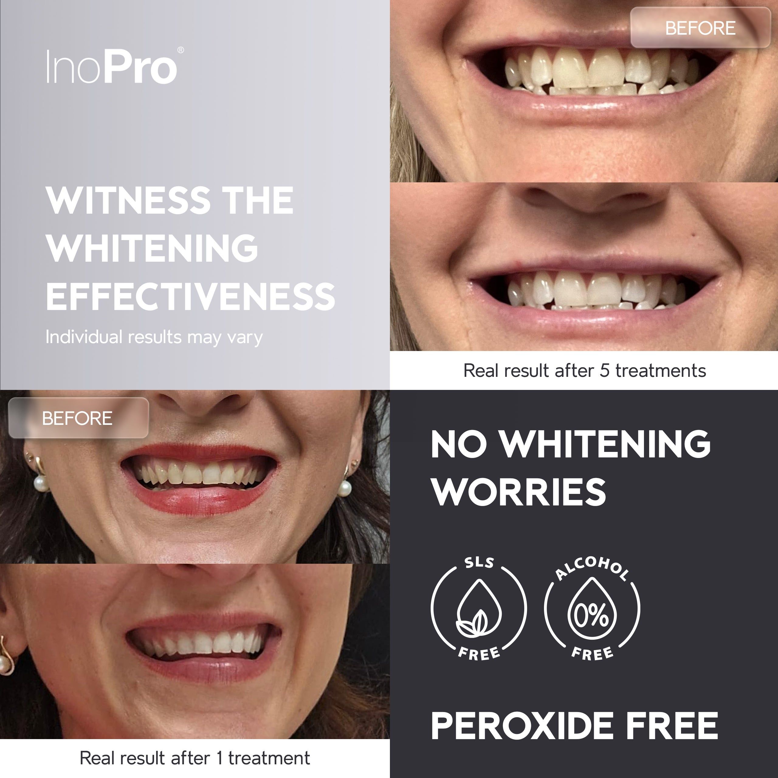 Confronto prima e dopo lo sbiancamento dei denti con INOPRO, mostra i risultati dopo 1 e 5 trattamenti.