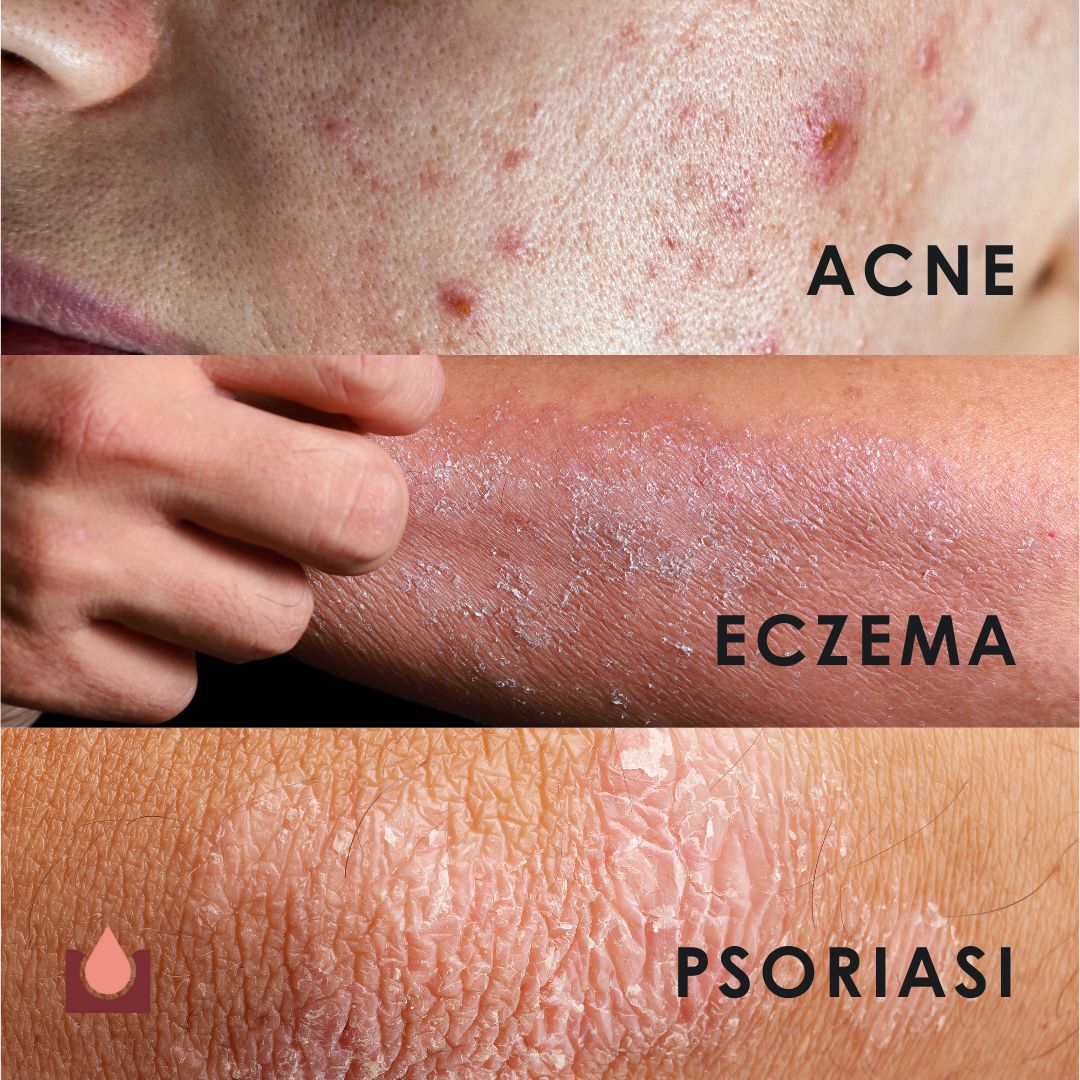 Primi piani di pelle con acne, eczema e psoriasi. Testo: Acne, eczema, psoriasi.
