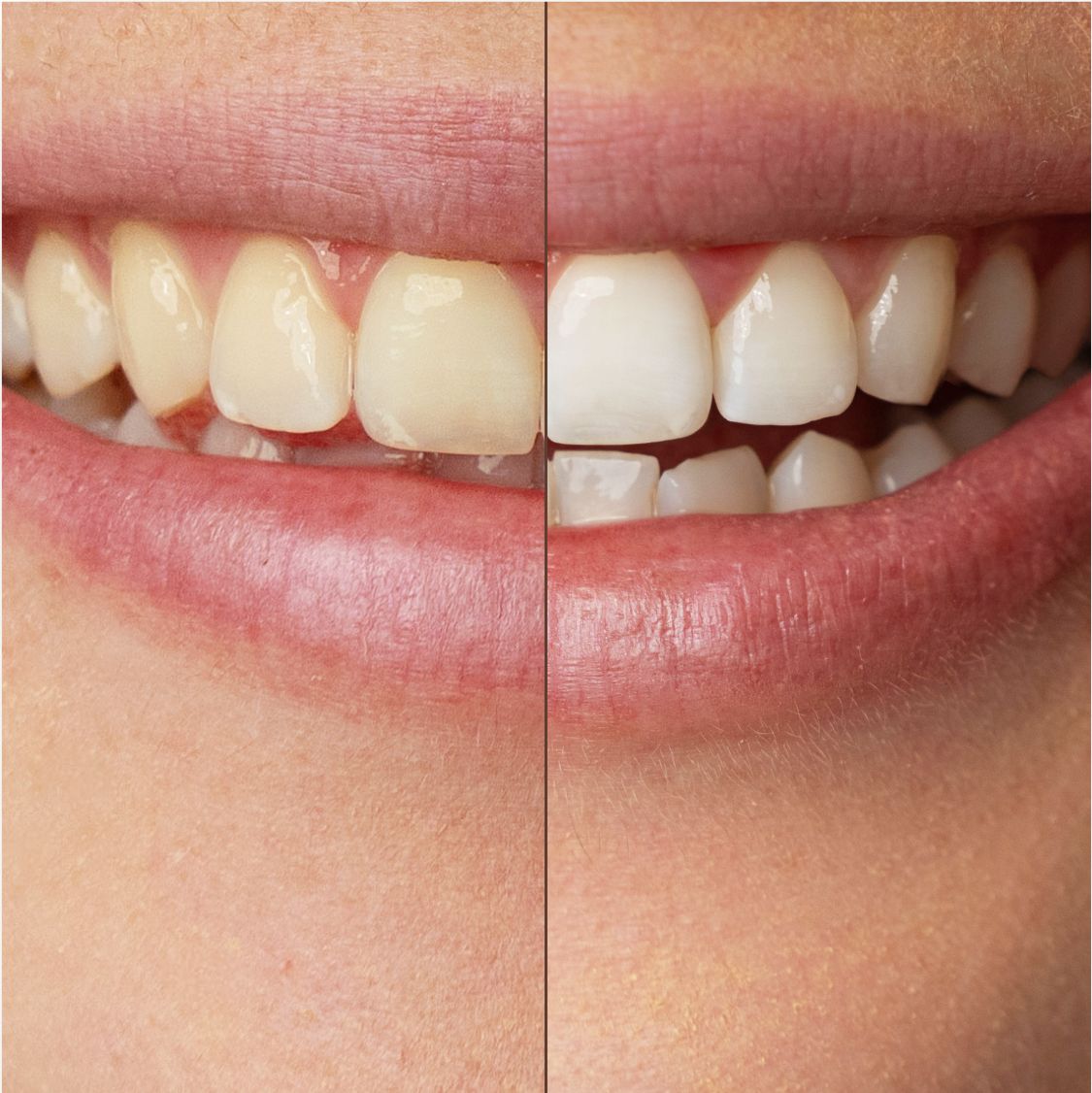 Confronto prima/dopo. Denti. 0% vs. 83% sbiancamento dopo 1 applicazione.