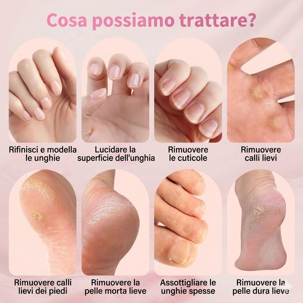Vari problemi di unghie e piedi. Unghie danneggiate, calli, duroni, pelle morta. Mostrato su mani e piedi.