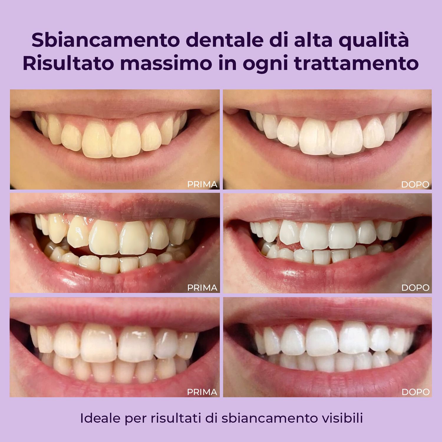 Confronto prima-dopo dei denti. Diverse file mostrano i risultati dello sbiancamento.