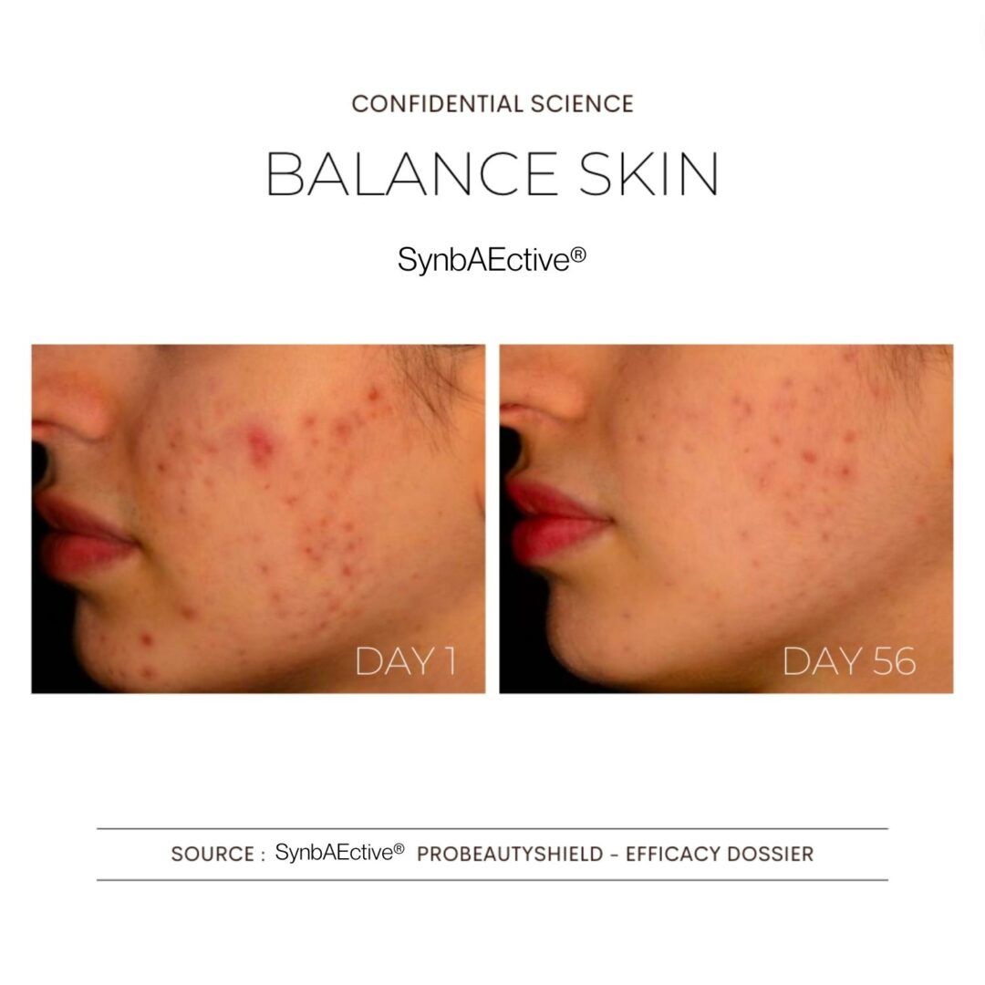 Immagine prima-dopo. Viso con acne. Giorno 1 e giorno 56. Testo: Balance Skin, SynBaActive.