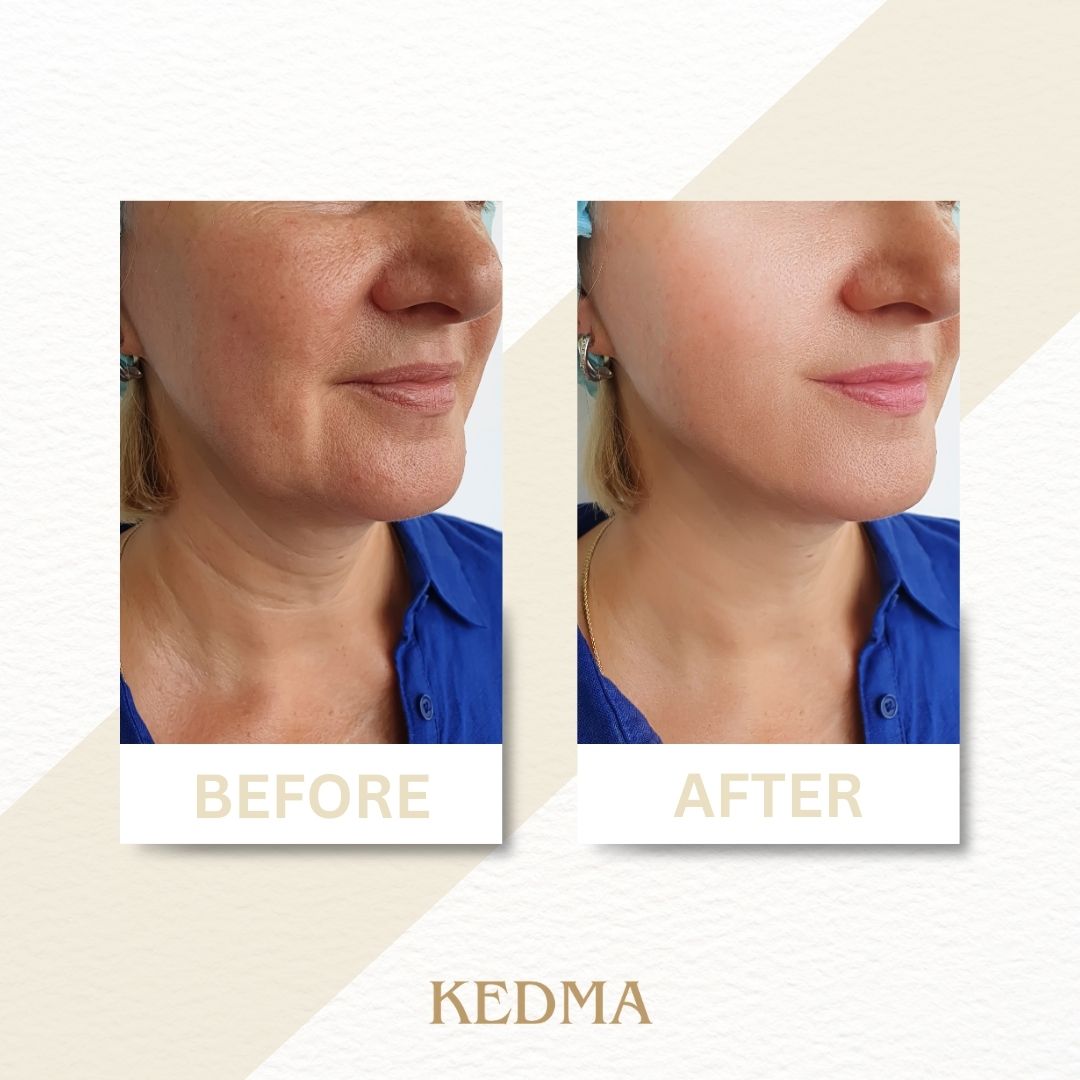 Kedma - Crema Collagene per Collo e Décolleté con Minerali del Mar Morto