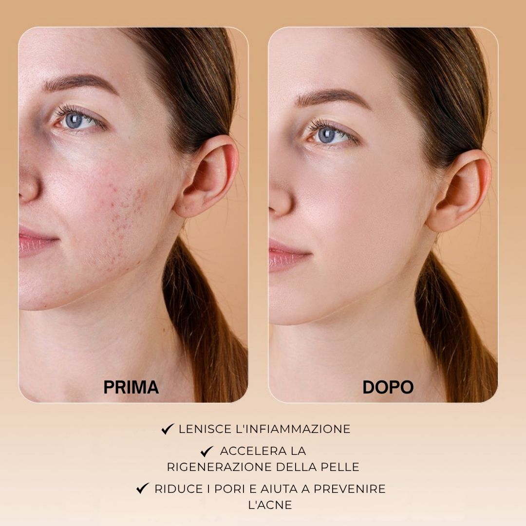Immagine prima-dopo. Viso con imperfezioni, poi pelle chiara. Testo: Lenisce l'infiammazione, ecc.