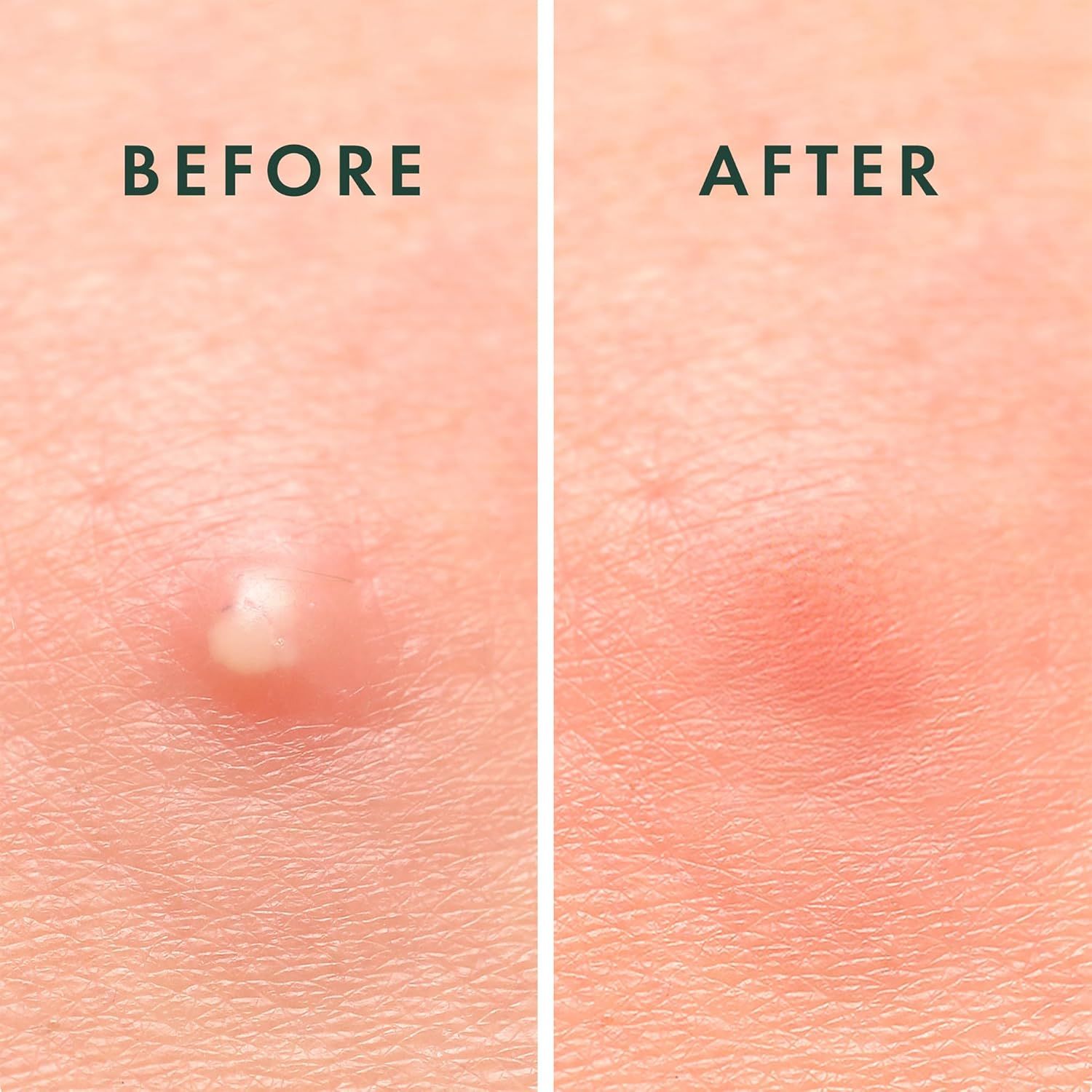 Due immagini affiancate: Prima e Dopo. Prima: brufolo. Dopo: arrossamento.