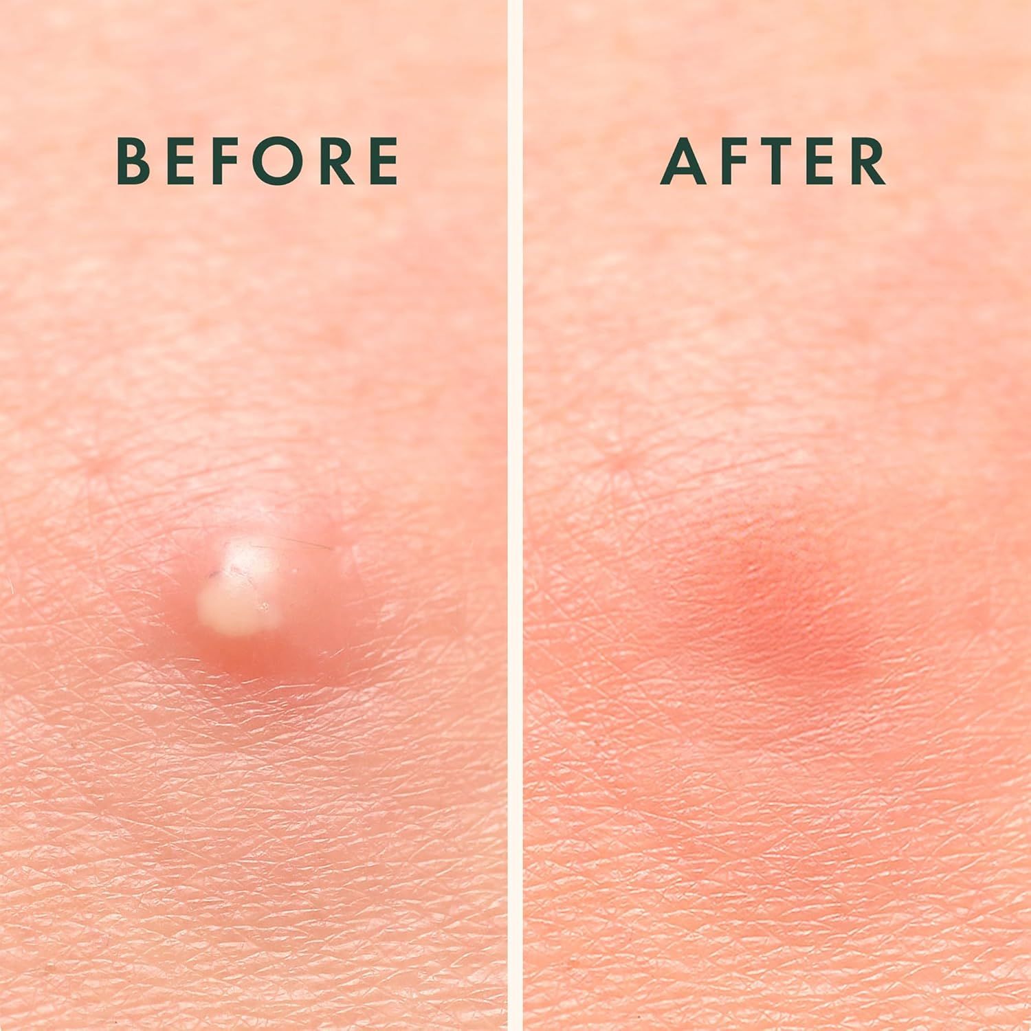 Confronto prima-dopo di un'eruzione cutanea. Sinistra: eruzione cutanea. Destra: arrossamento. Nessuna etichetta.