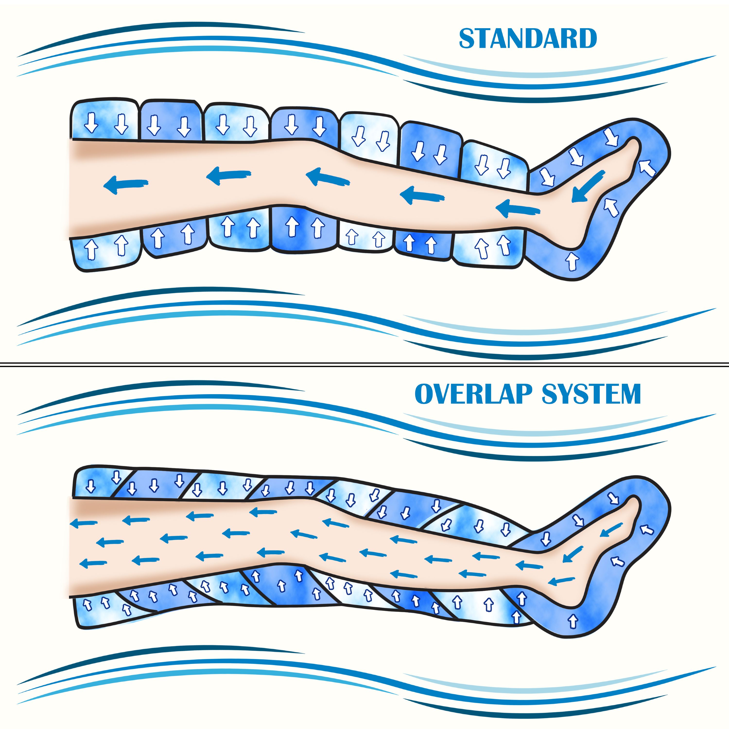 Illustrazione mostra due manicotti di compressione attorno a una gamba: standard e sistema a sovrapposizione. Le frecce indicano il flusso d'aria.