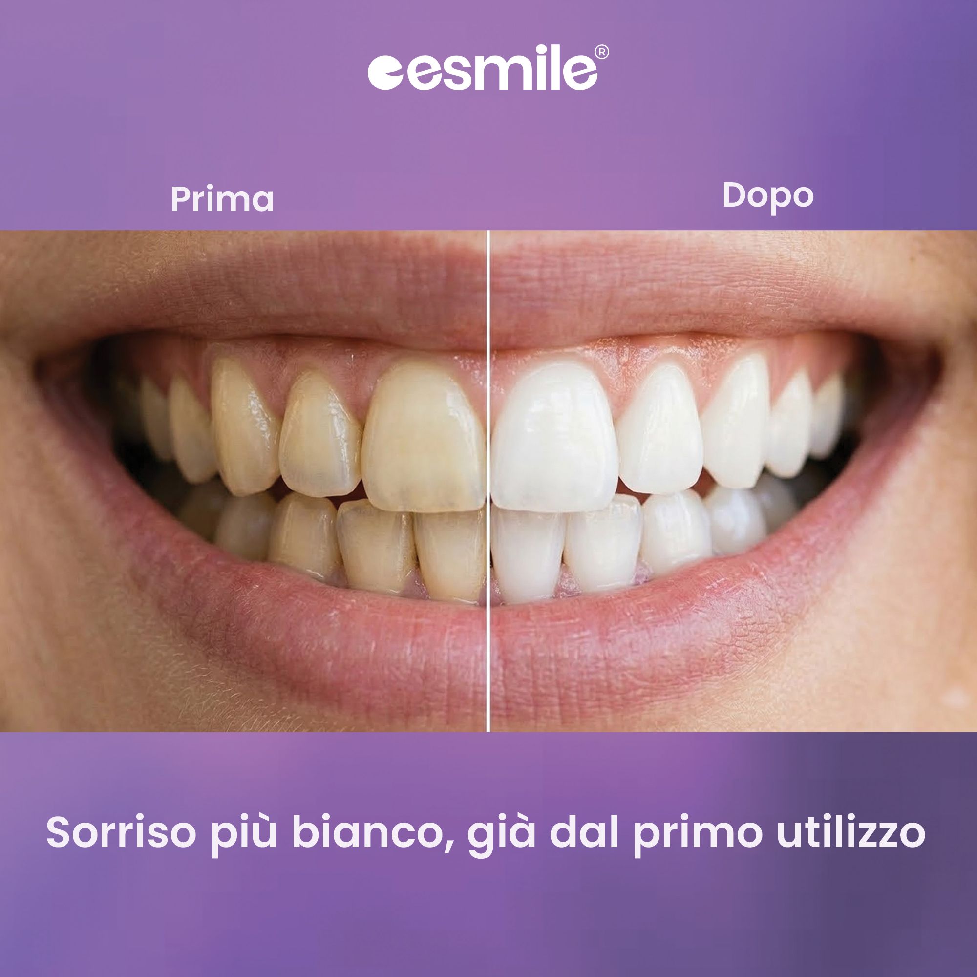 Confronto prima-dopo dei denti. Lato sinistro: denti giallastri. Lato destro: denti bianchi. Logo esmile.