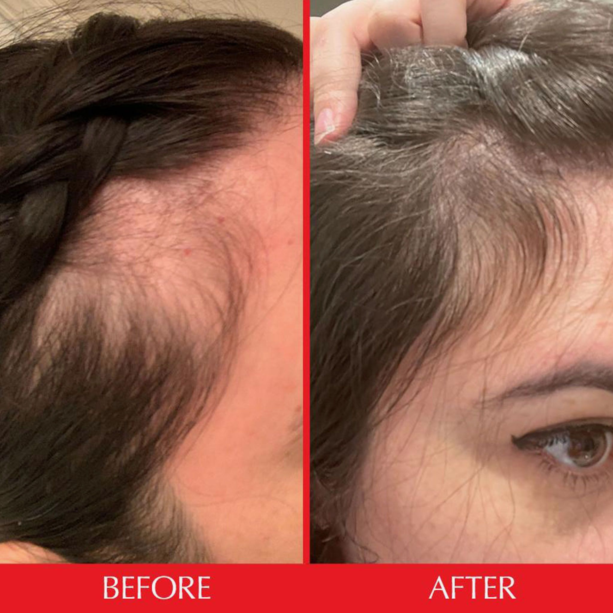 Confronto prima e dopo: perdita di capelli prima e dopo l'uso. Entrambe le immagini mostrano l'attaccatura dei capelli.