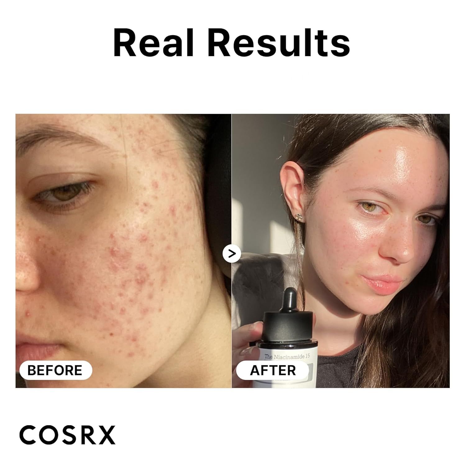 Confronto prima/dopo di pelle acneica trattata con siero COSRX Niacinamide 15.