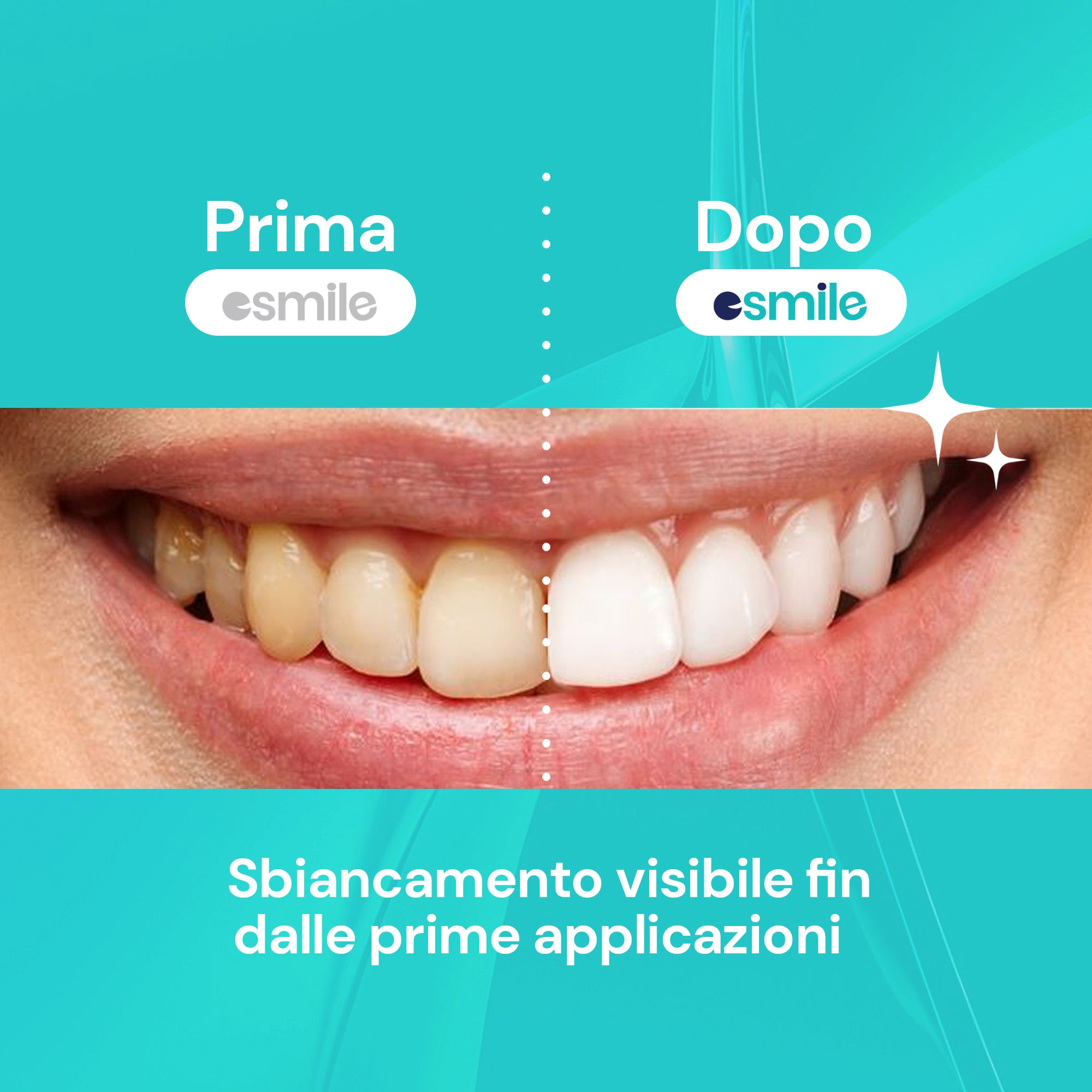 esmile - Carbone V34 Viola Sbiancante Denti