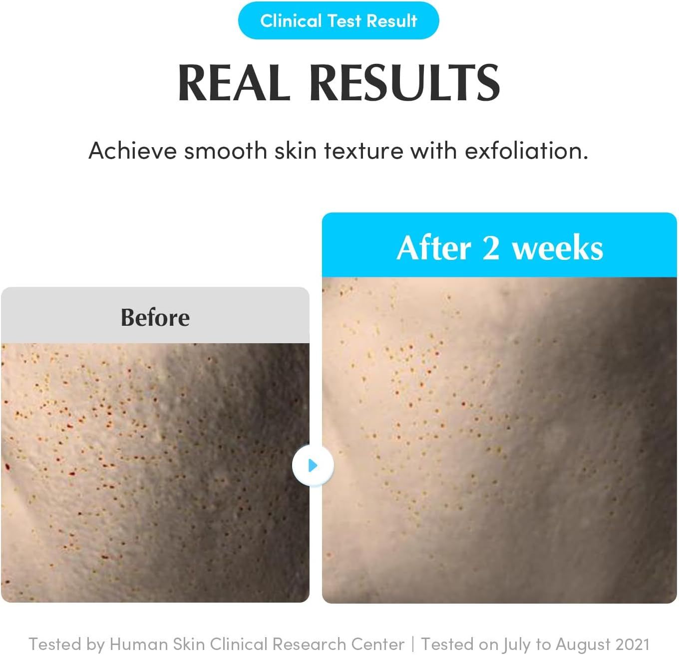 Confronto prima-dopo della pelle. Dopo 2 settimane. Pori ridotti, texture più liscia.