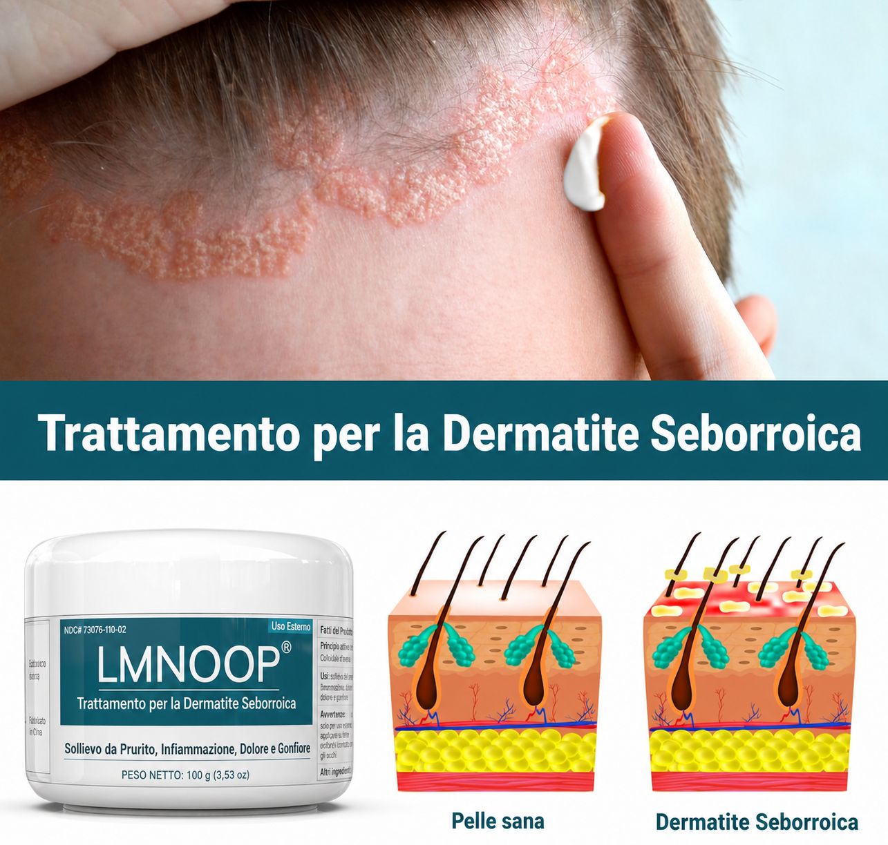 LMNOOP crema per dermatite seborroica trattamento intensivo per il cuoio capelluto