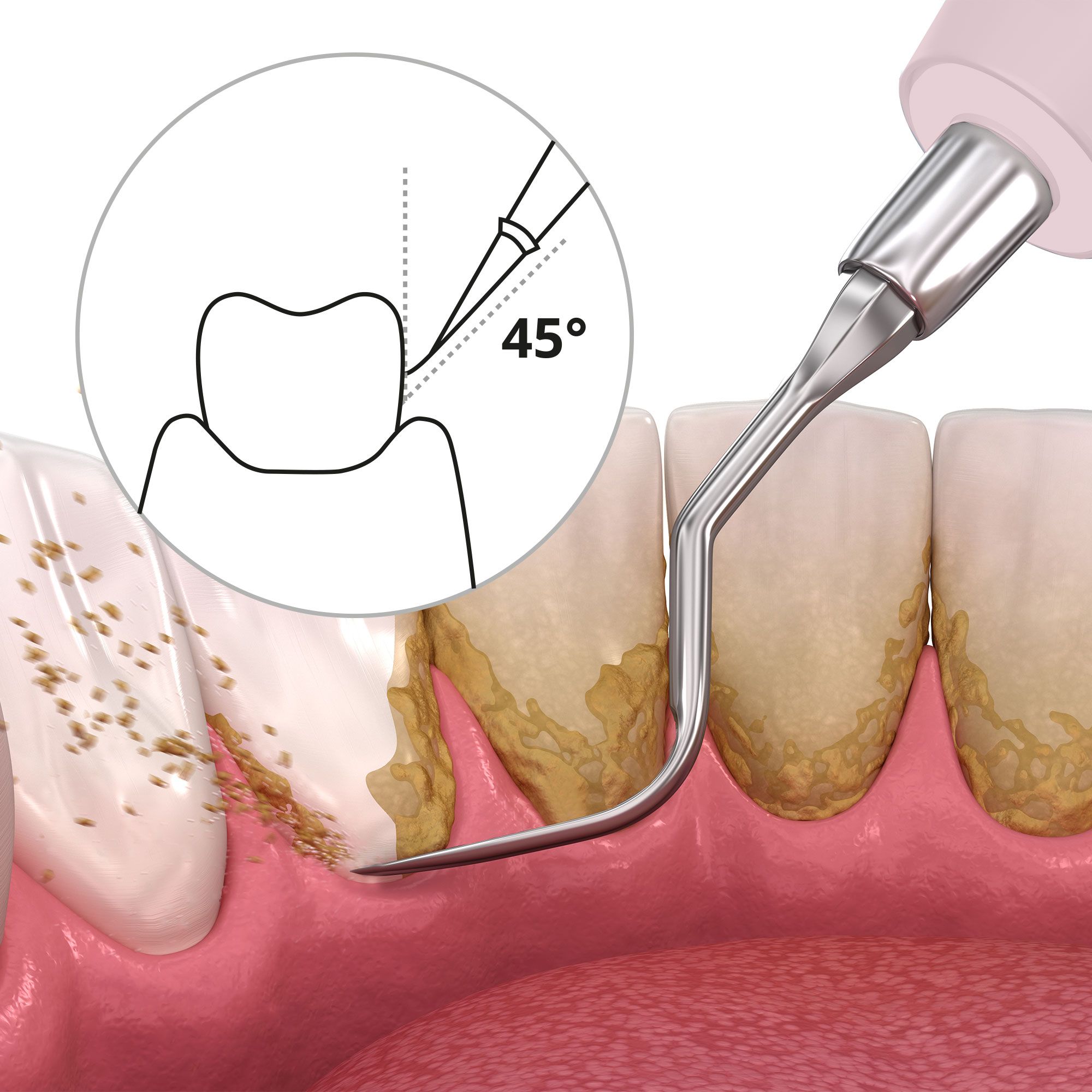 Pulitore dentale in uso. Illustrazione dell'applicazione. Angolo di 45 gradi.