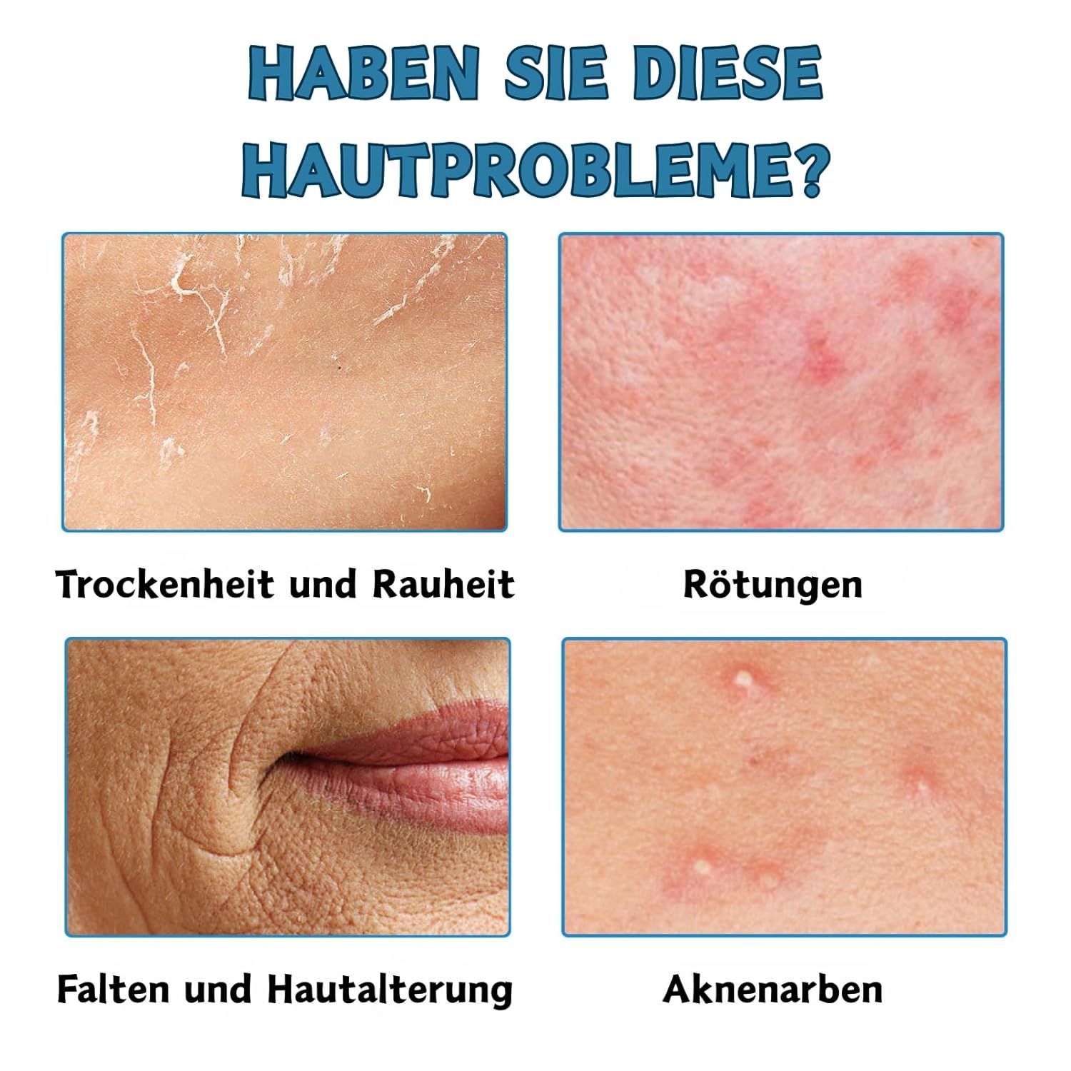 SUMMISHI Sistema Micro Infusion: Roller Microneedling