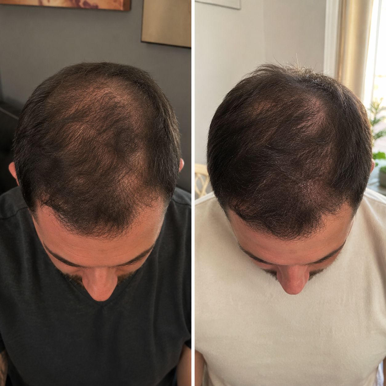 Confronto cuoio capelluto prima e dopo trattamento. Notevole miglioramento della densità dei capelli.