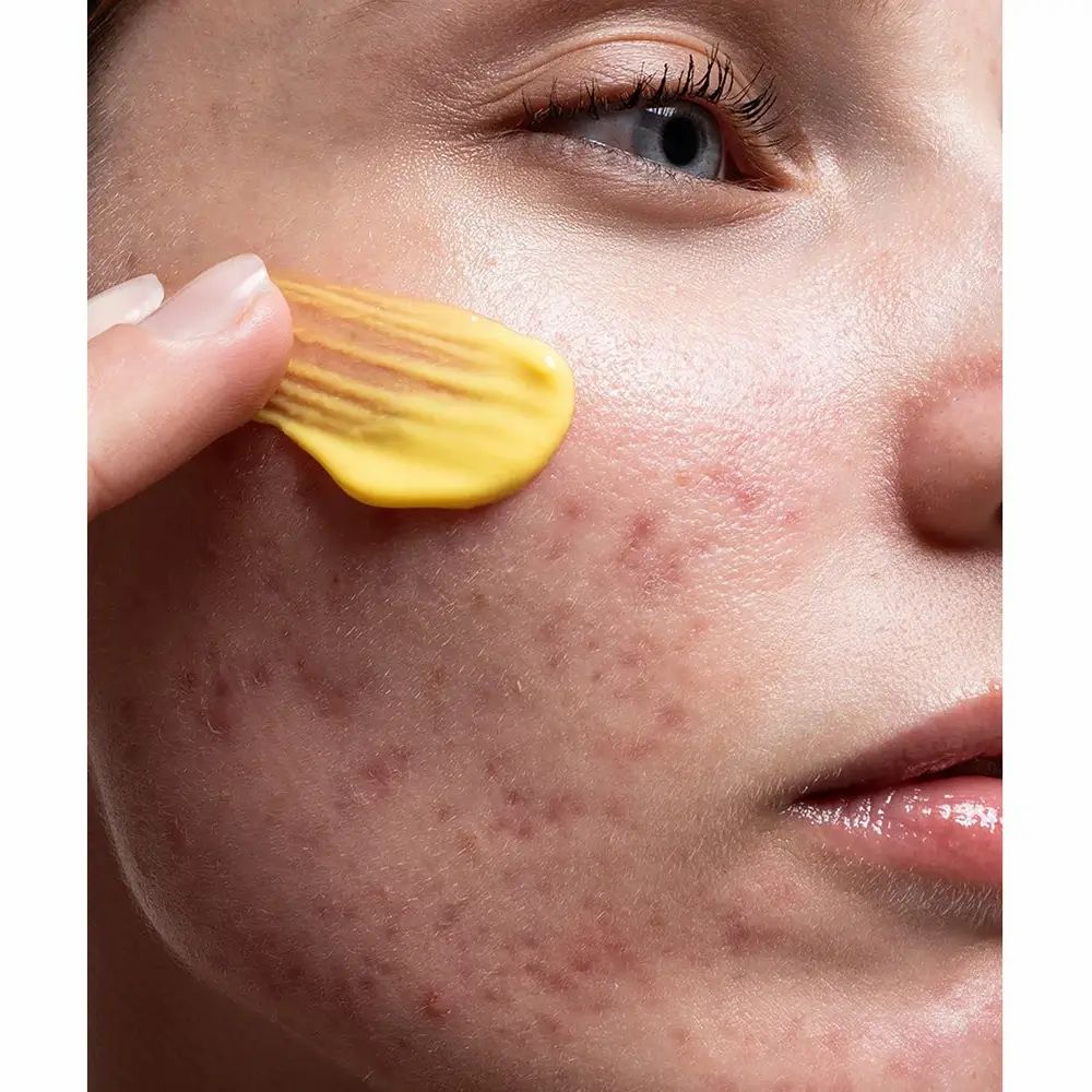 Crema gialla applicata sul viso. Pelle con arrossamenti e brufoli. Dito che tocca la crema.
