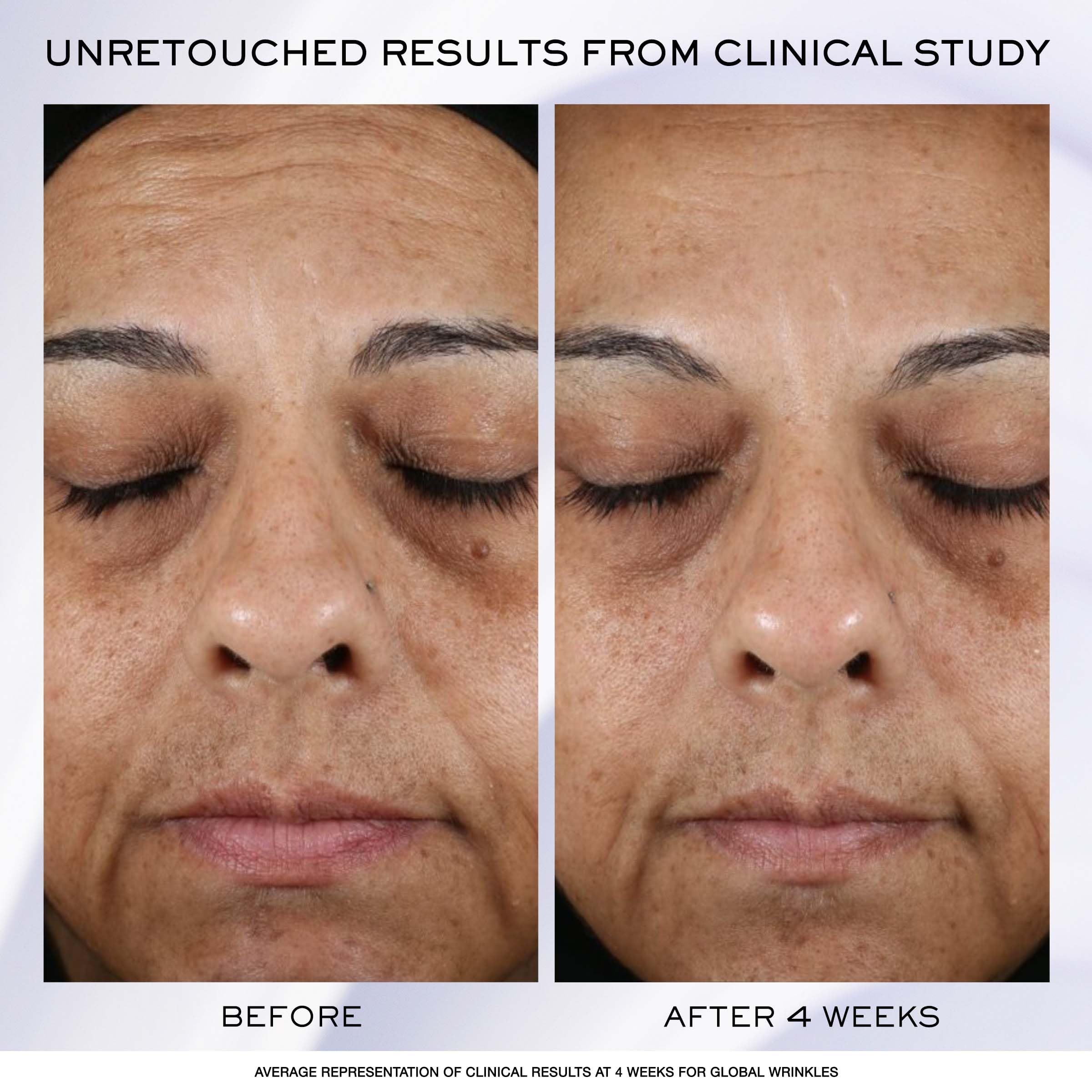 Confronto prima-dopo. Foto del viso. Prima: rughe, macchie. Dopo 4 settimane: miglioramenti. LANCÔME RÉNERGIE.