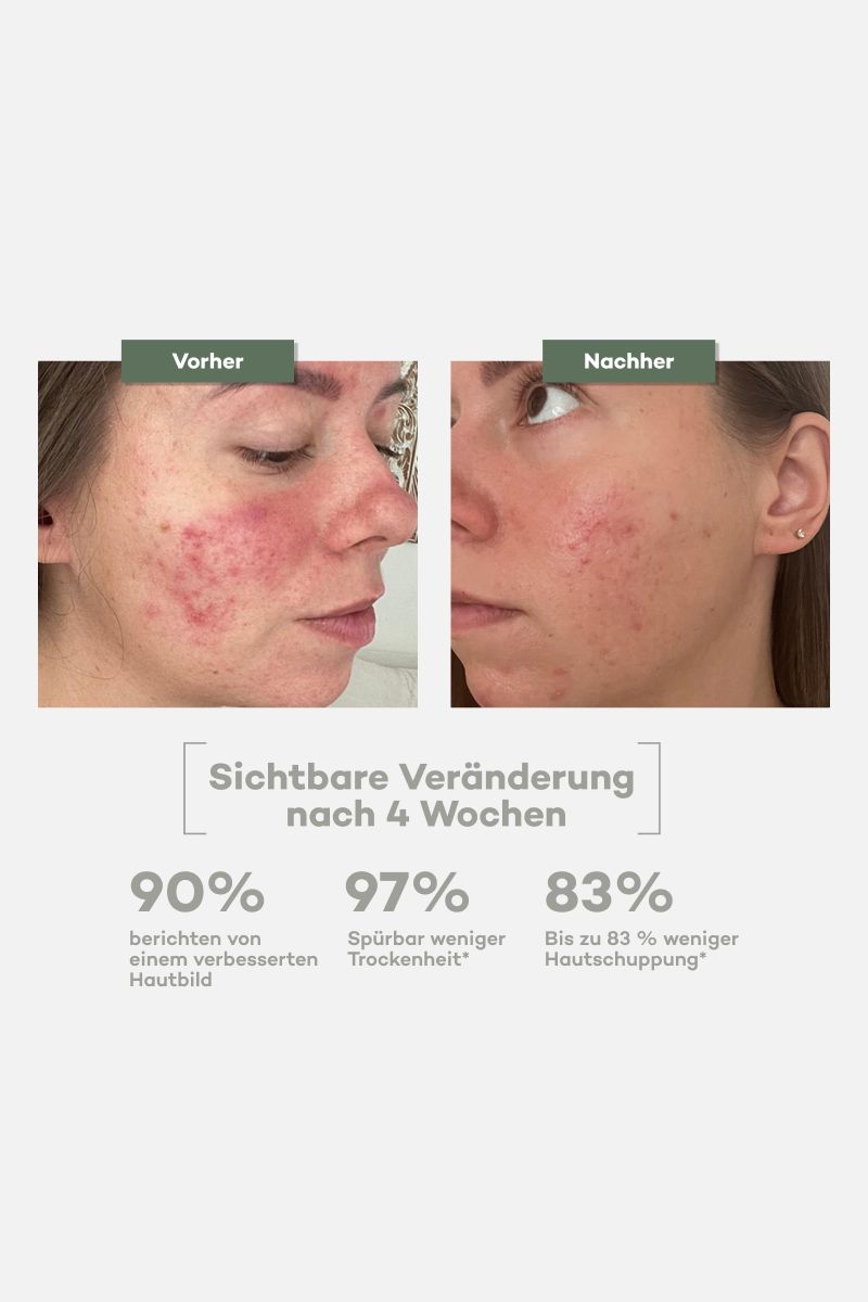 Immagini comparative: Prima/Dopo. Riduzione arrossamenti cutanei. Testo: Cambiamento visibile dopo 4 settimane. Percentuali.