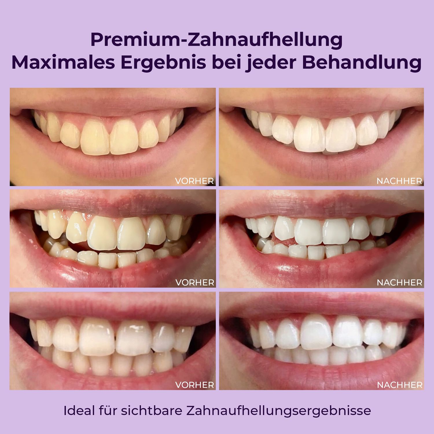 Immagini prima-dopo dei denti. Mostra i risultati dello sbiancamento. Ideale per risultati visibili.