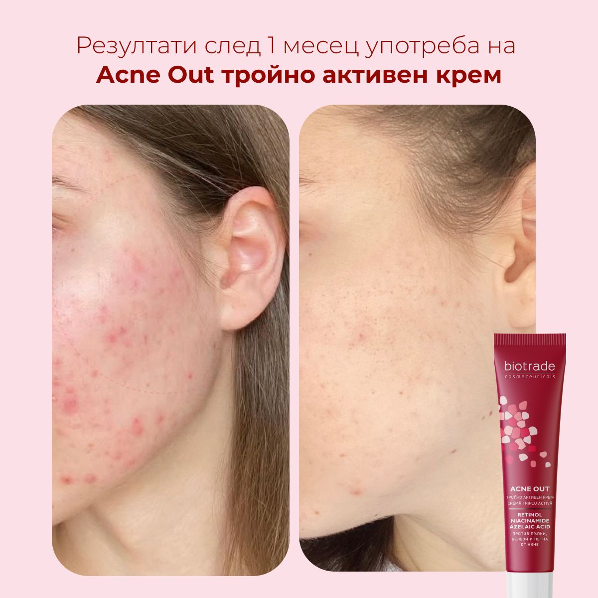 Confronto prima-dopo di pelle con acne. Accanto, tubo con scritta: ACNE OUT, Retinolo, Niacinamide, Acido Azelaico. Marchio: Biotrade.