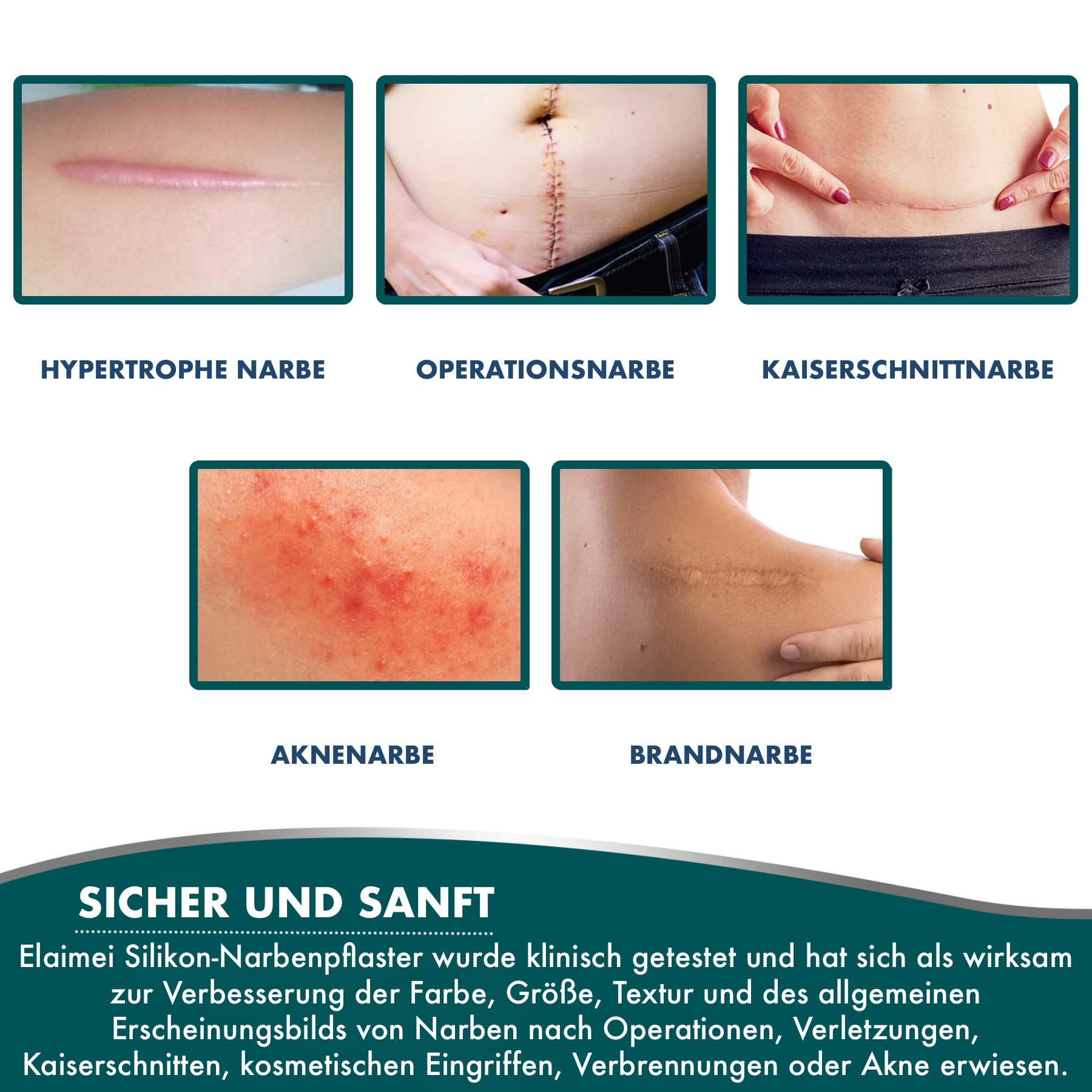 Diversi tipi di cicatrici: cicatrice ipertrofica, cicatrice chirurgica, cicatrice da taglio cesareo, cicatrici da acne, cicatrice da ustione.