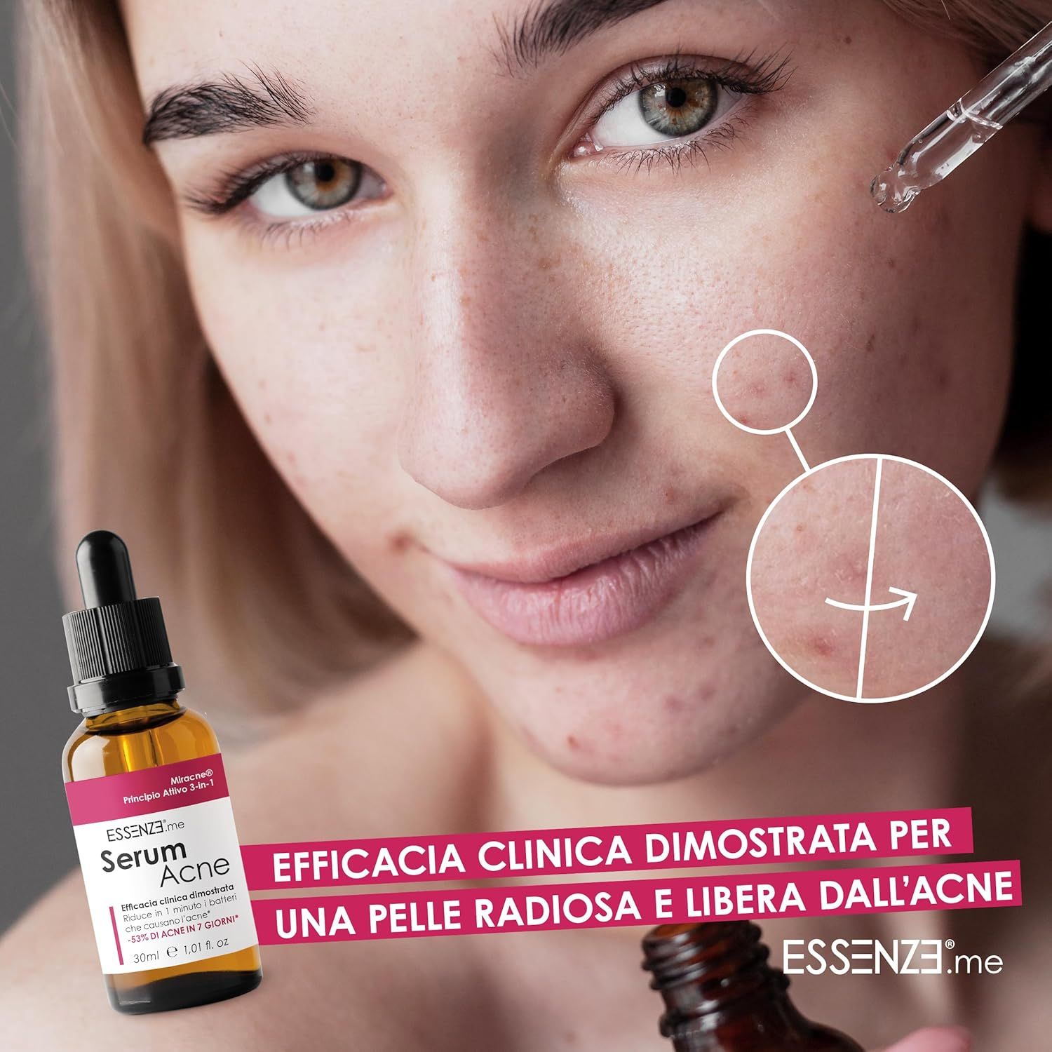 Essenze.me Serum Acne Siero Viso per Brufoli e Imperfezioni, Pelle Impura e a Tendenza Acneica 30 ml