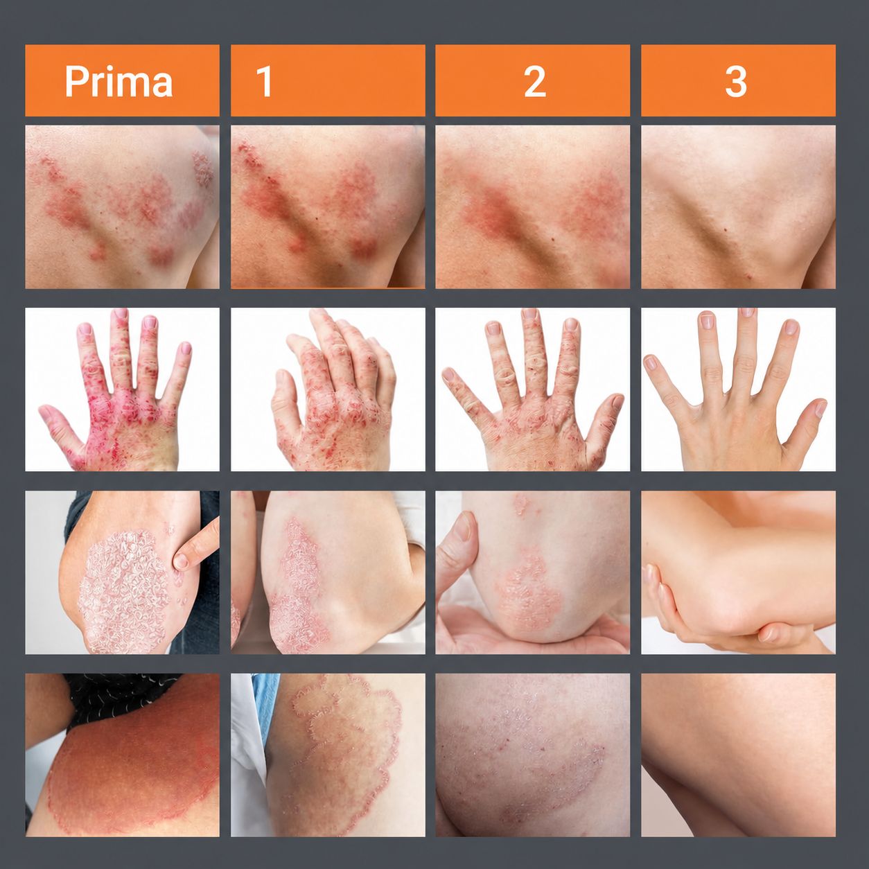 Immagini del prima e del dopo delle condizioni della pelle. Mostra eruzioni cutanee, eczema, psoriasi e prurito. 3 fasi di miglioramento.
