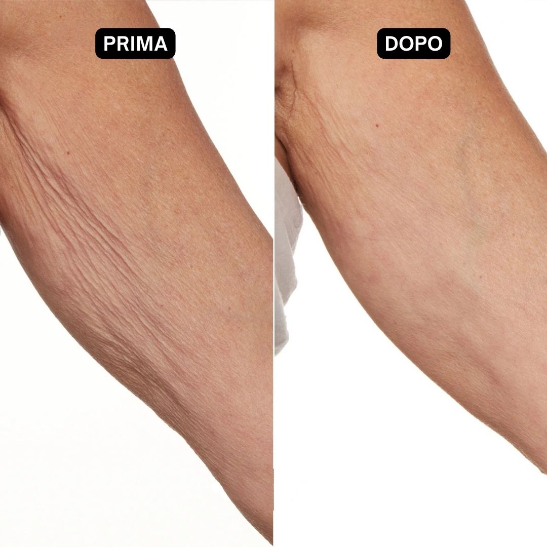 Due braccia, una con pelle rugosa, l'altra liscia. Testo: Prima/Dopo.