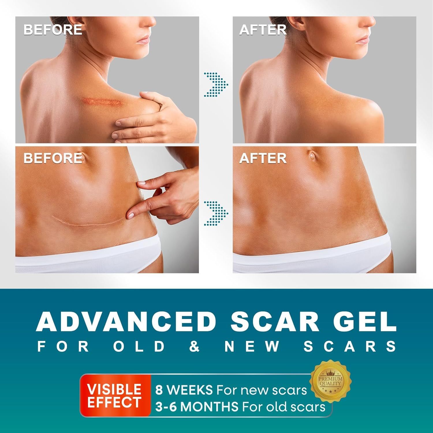 Confronto prima-dopo di cicatrici. UNIEDI Advanced Scar Gel. Per cicatrici vecchie e nuove. Effetto visibile in 8 settimane per nuove cicatrici.