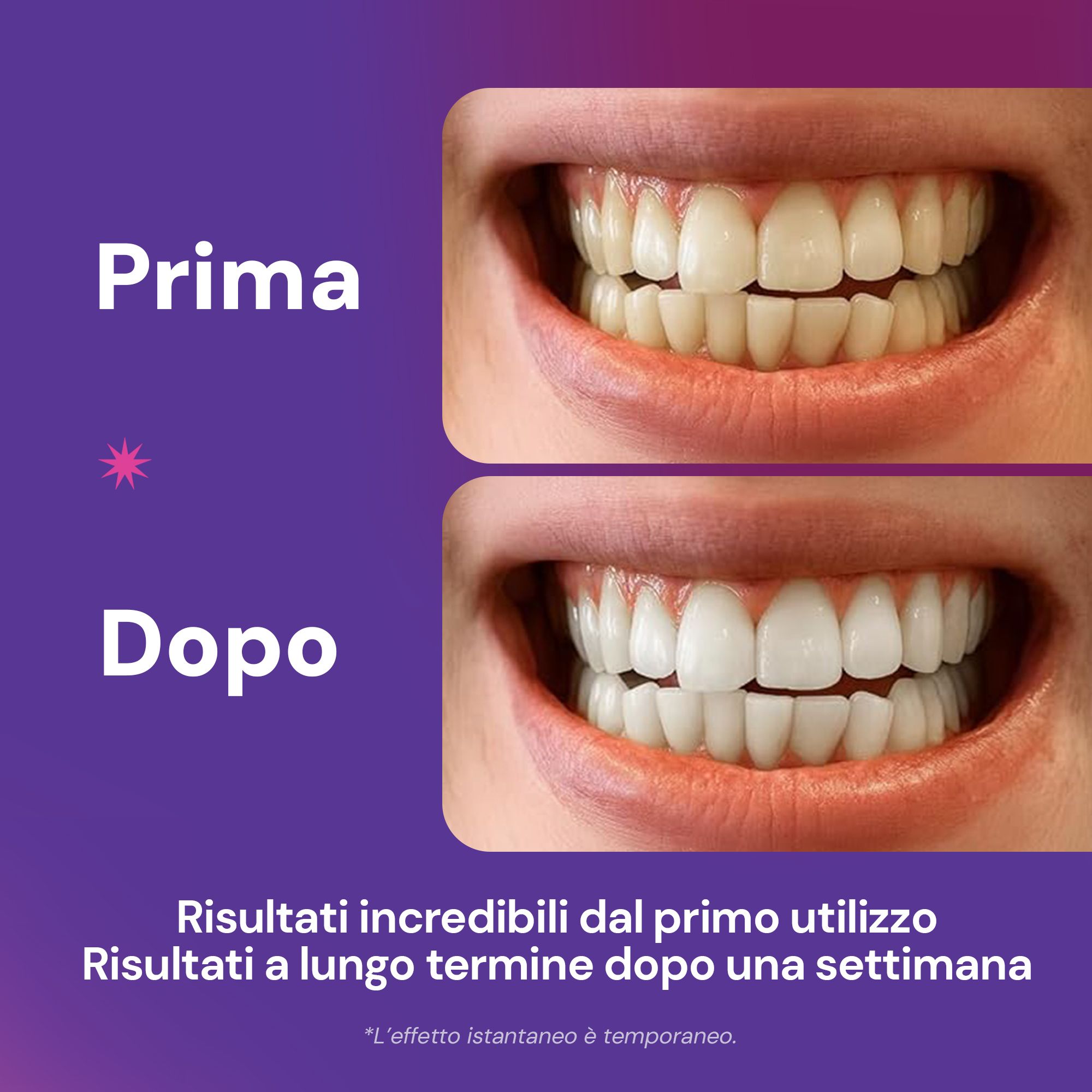 Confronto prima-dopo dei denti. Sopra: denti giallastri. Sotto: denti più bianchi. Testo: Risultati incredibili dal primo utilizzo.