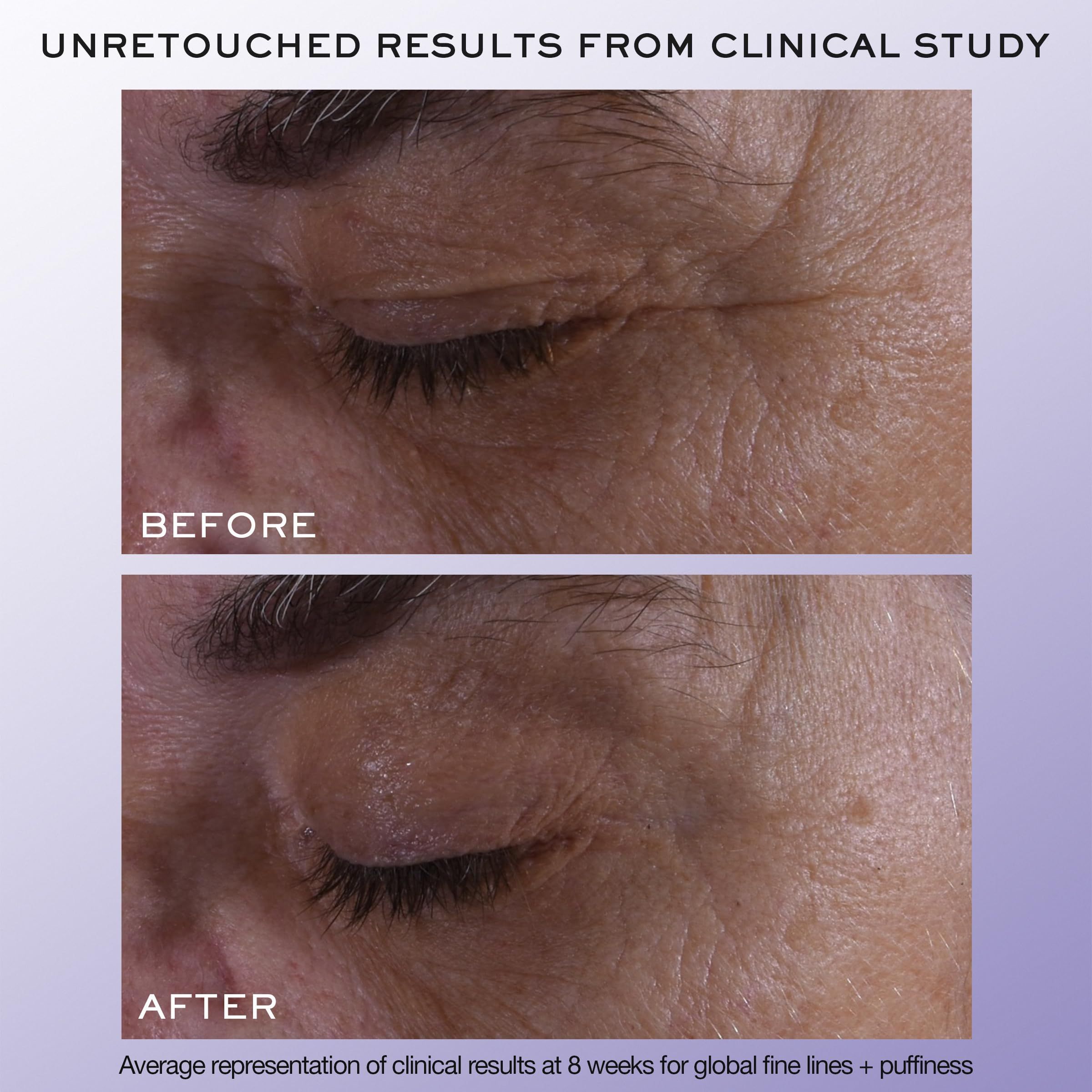 Primo piano degli occhi prima e dopo. Mostra la riduzione delle rughe. Scritta: Before, After.