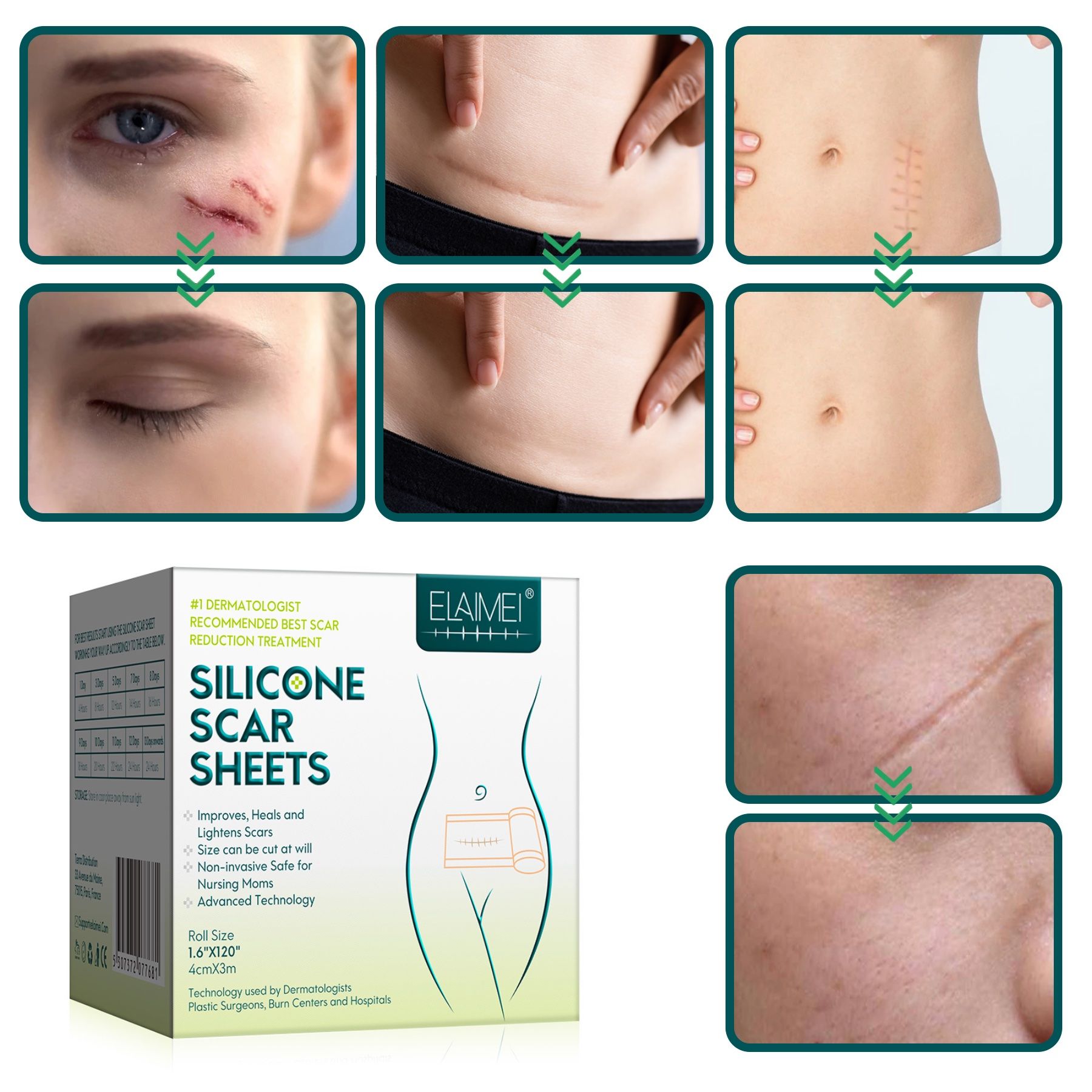 Immagini prima e dopo dei trattamenti delle cicatrici con ELAIMEI SILICONE SCAR SHEETS. Confezione sullo sfondo.