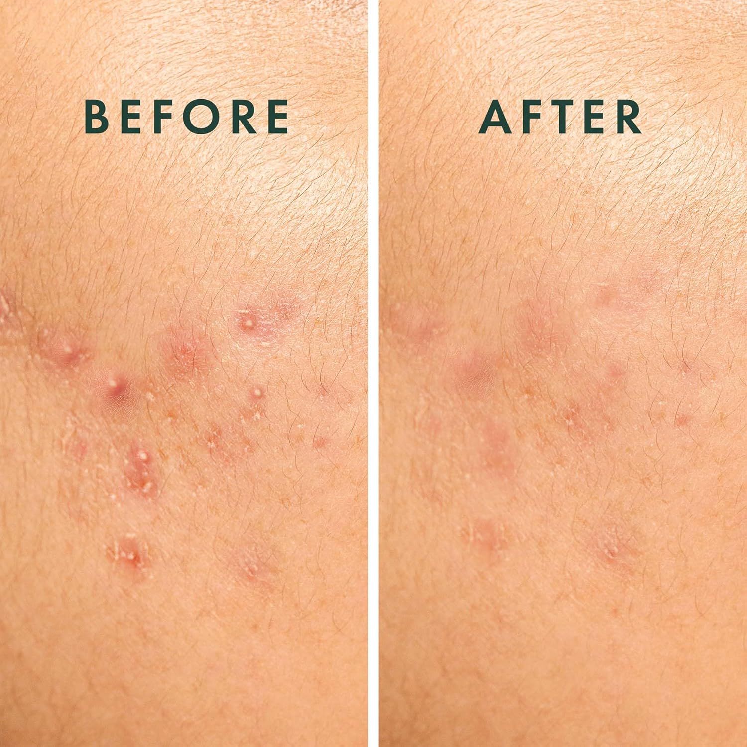 Due primi piani di aree cutanee. Sinistra: pelle con brufoli. Destra: pelle dopo il trattamento.