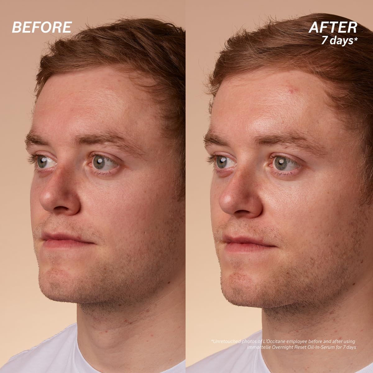 Confronto prima-dopo di due ritratti di uomini. Sinistra: pelle prima dell'uso. Destra: pelle dopo 7 giorni.